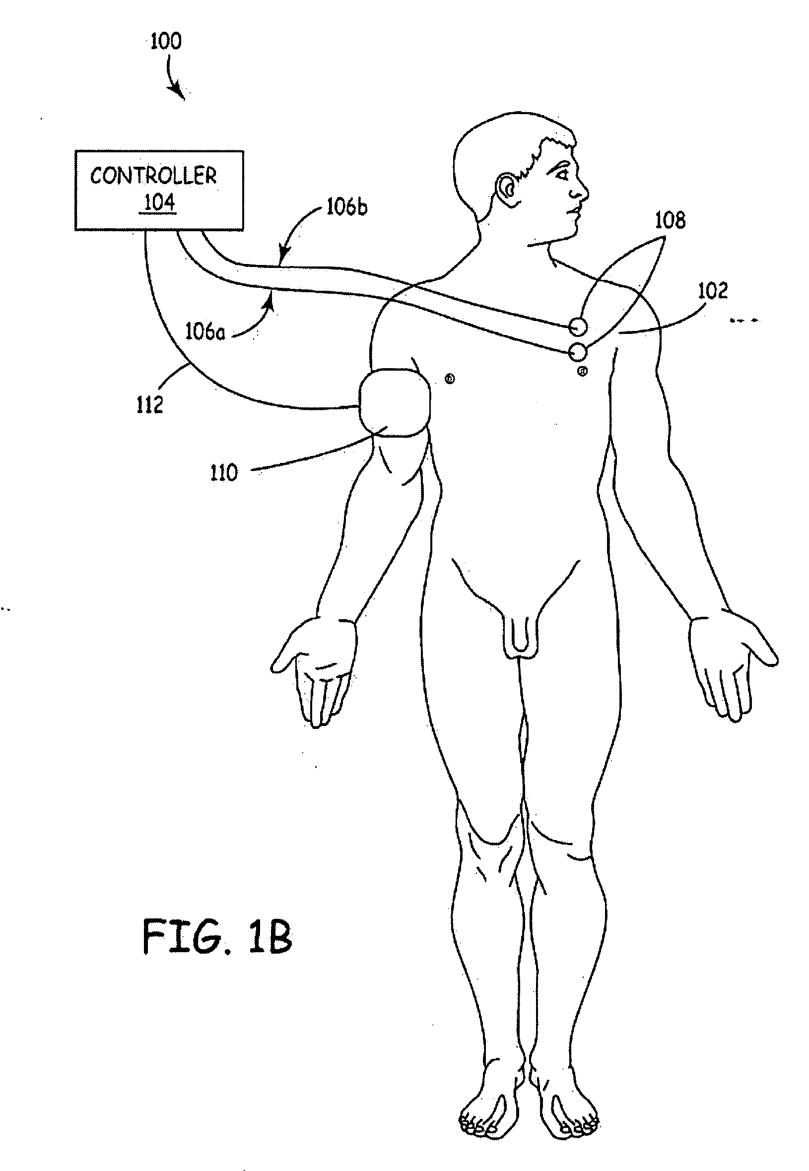 Method and apparatus to minimize the effects of a cardiac insult