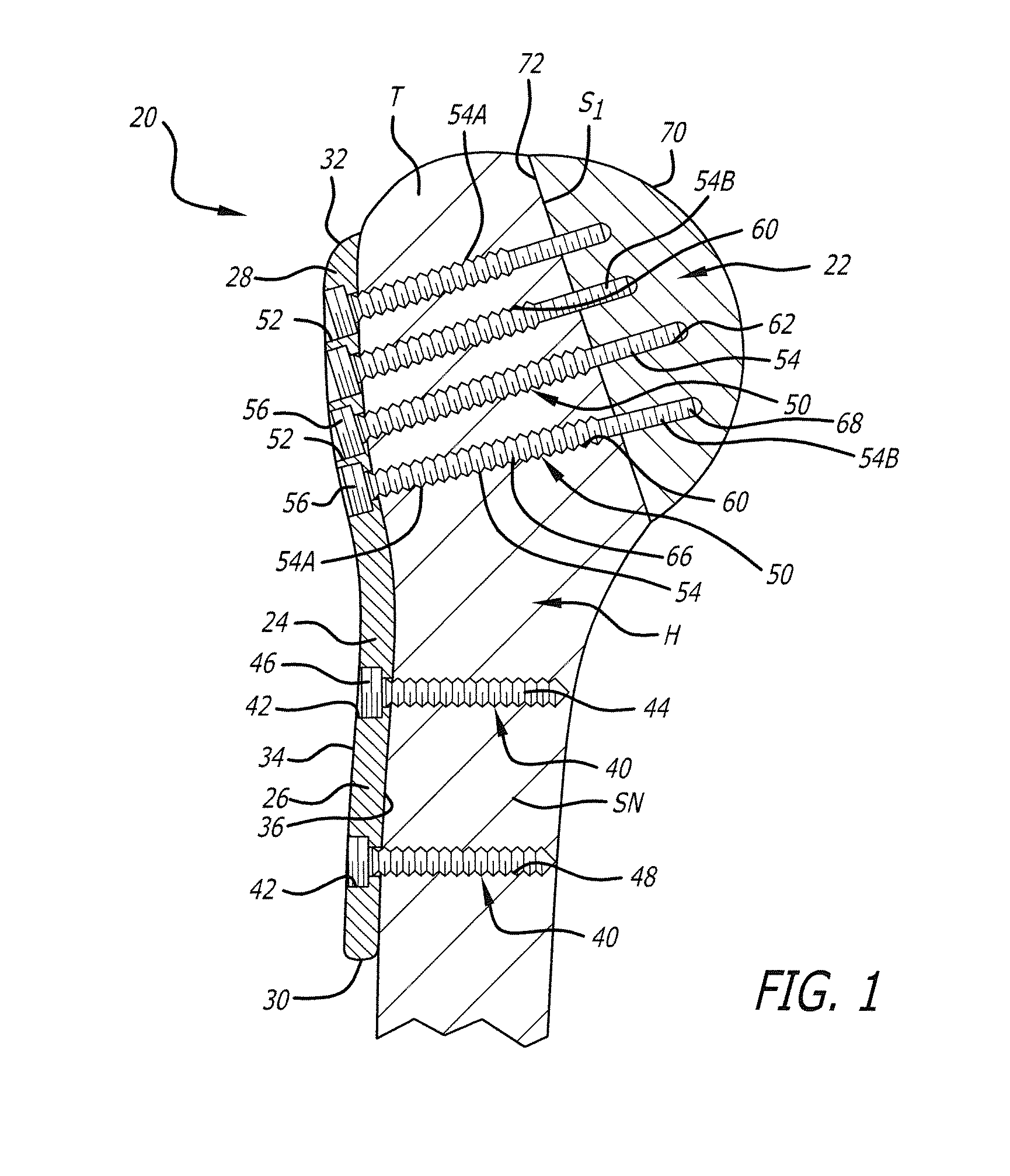 System and method for fracture replacement of comminuted bone fractures or portions thereof adjacent bone joints