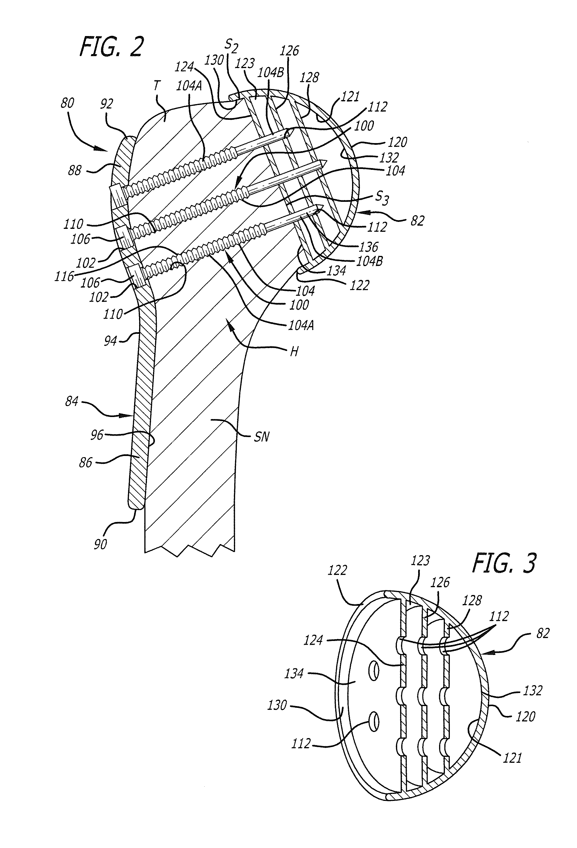 System and method for fracture replacement of comminuted bone fractures or portions thereof adjacent bone joints
