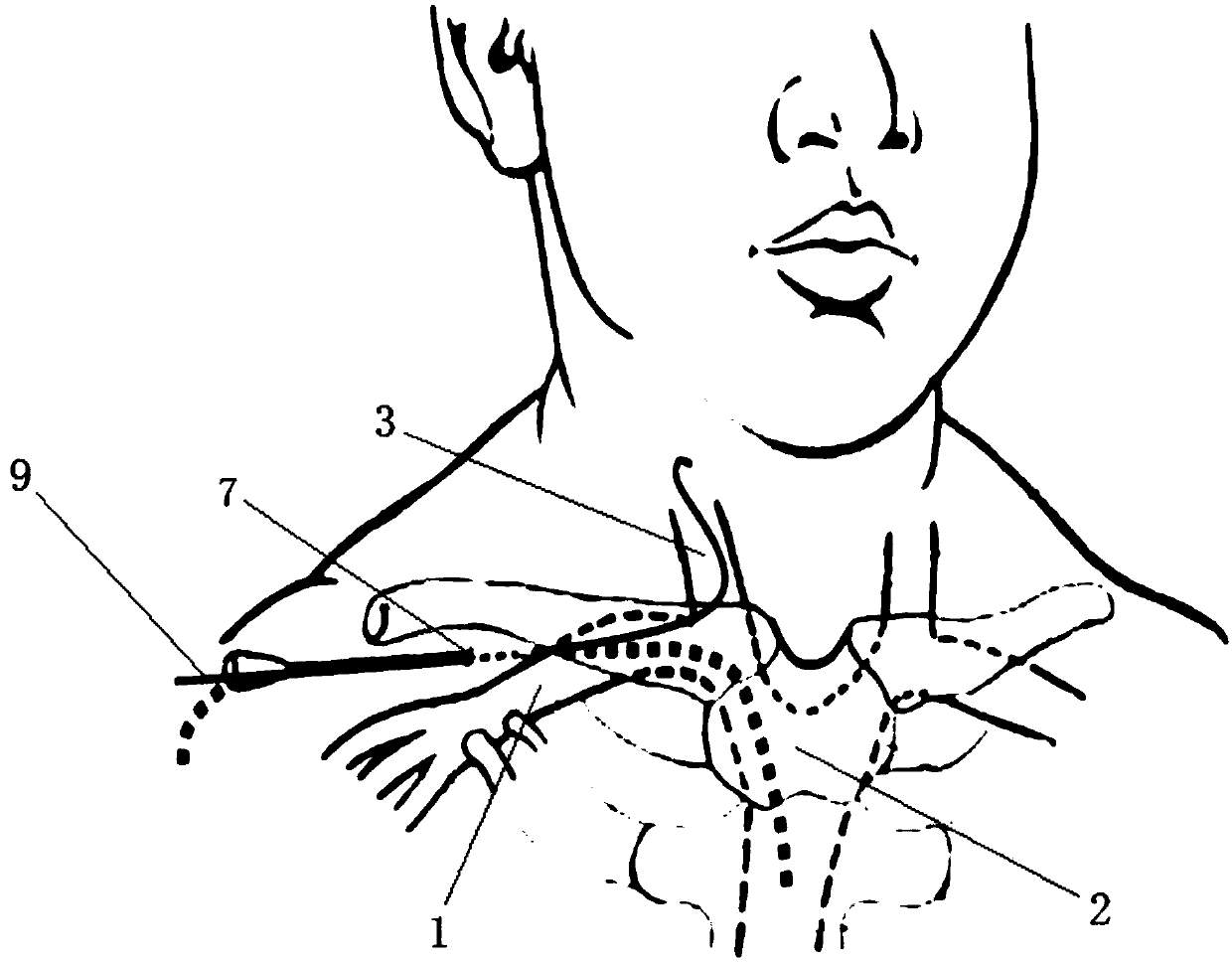 Subclavian vein puncture catheterization method