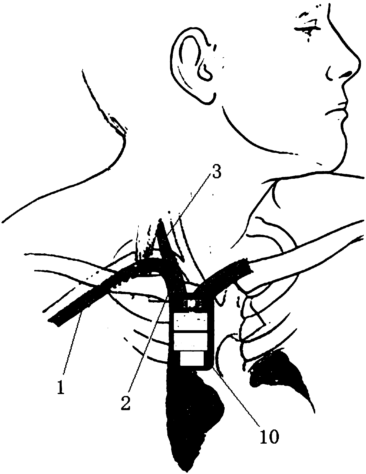 Subclavian vein puncture catheterization method