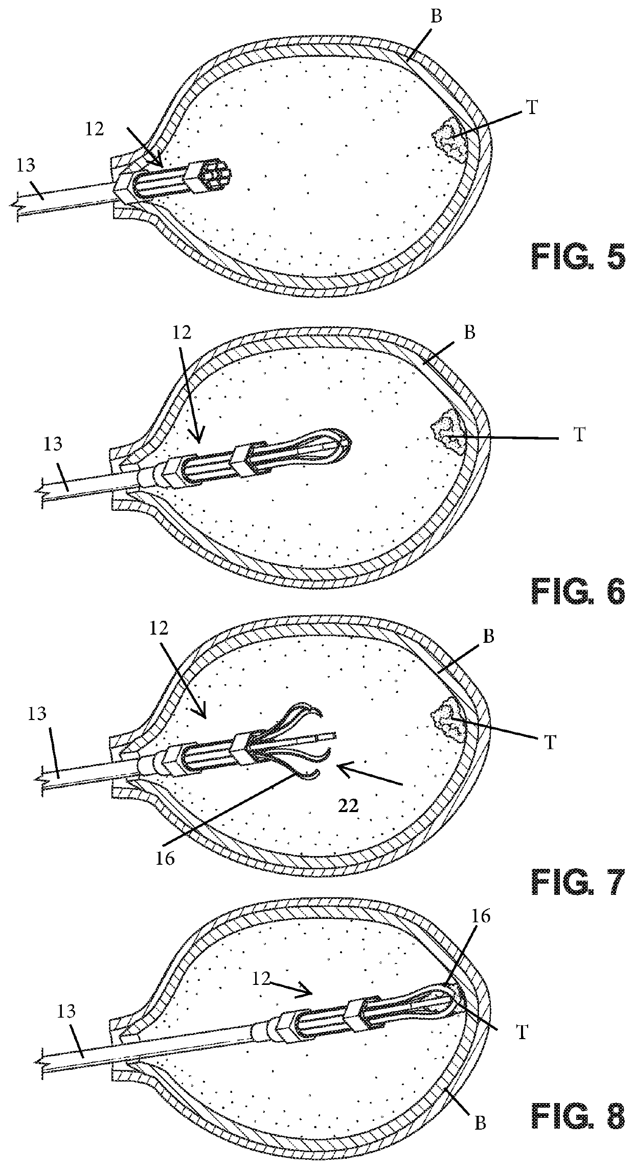 Tumor enucleator and method of use
