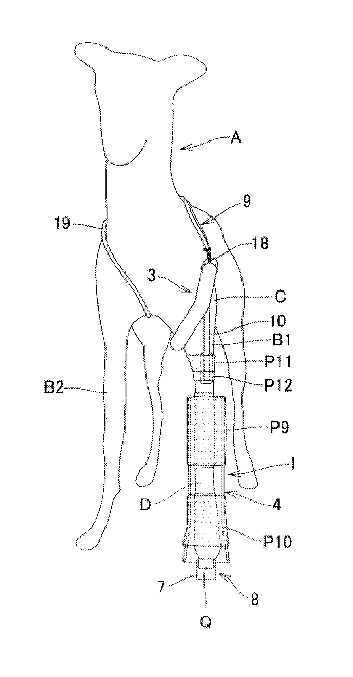 External fixation device for fracture treatment of animals and method for treating fractures of animals using the device