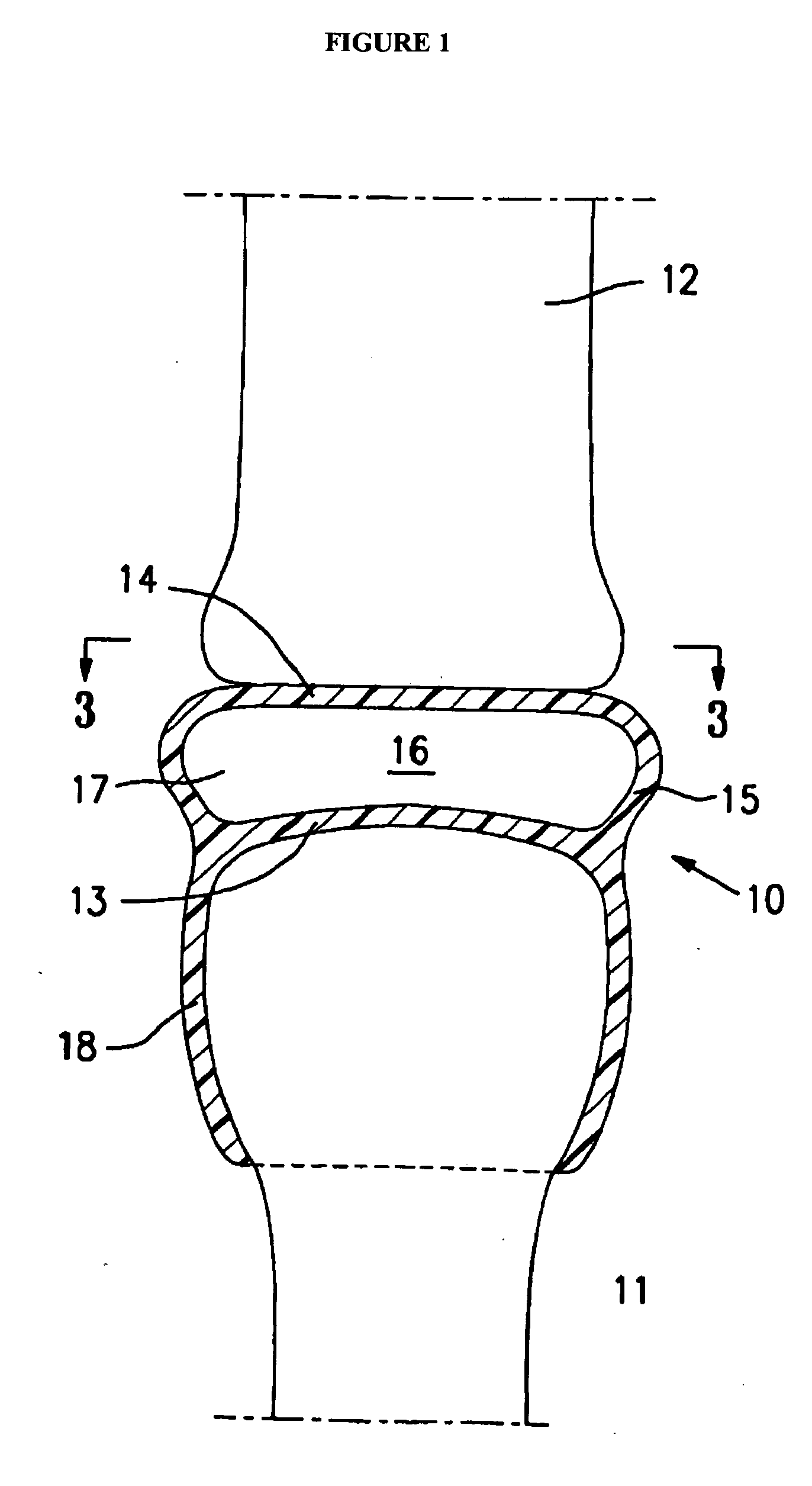 Resilient medically inflatable interpositional arthroplasty device
