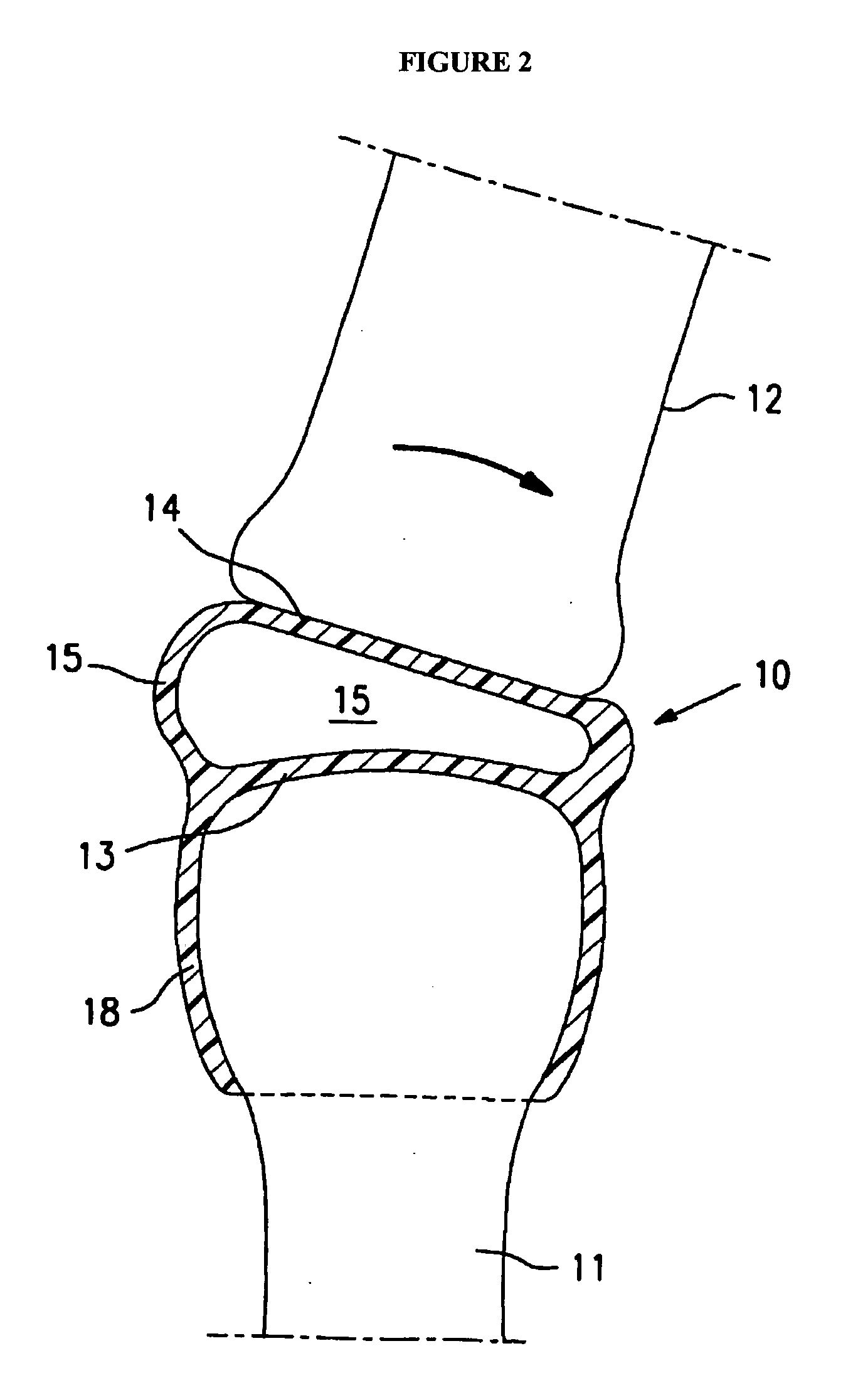 Resilient medically inflatable interpositional arthroplasty device