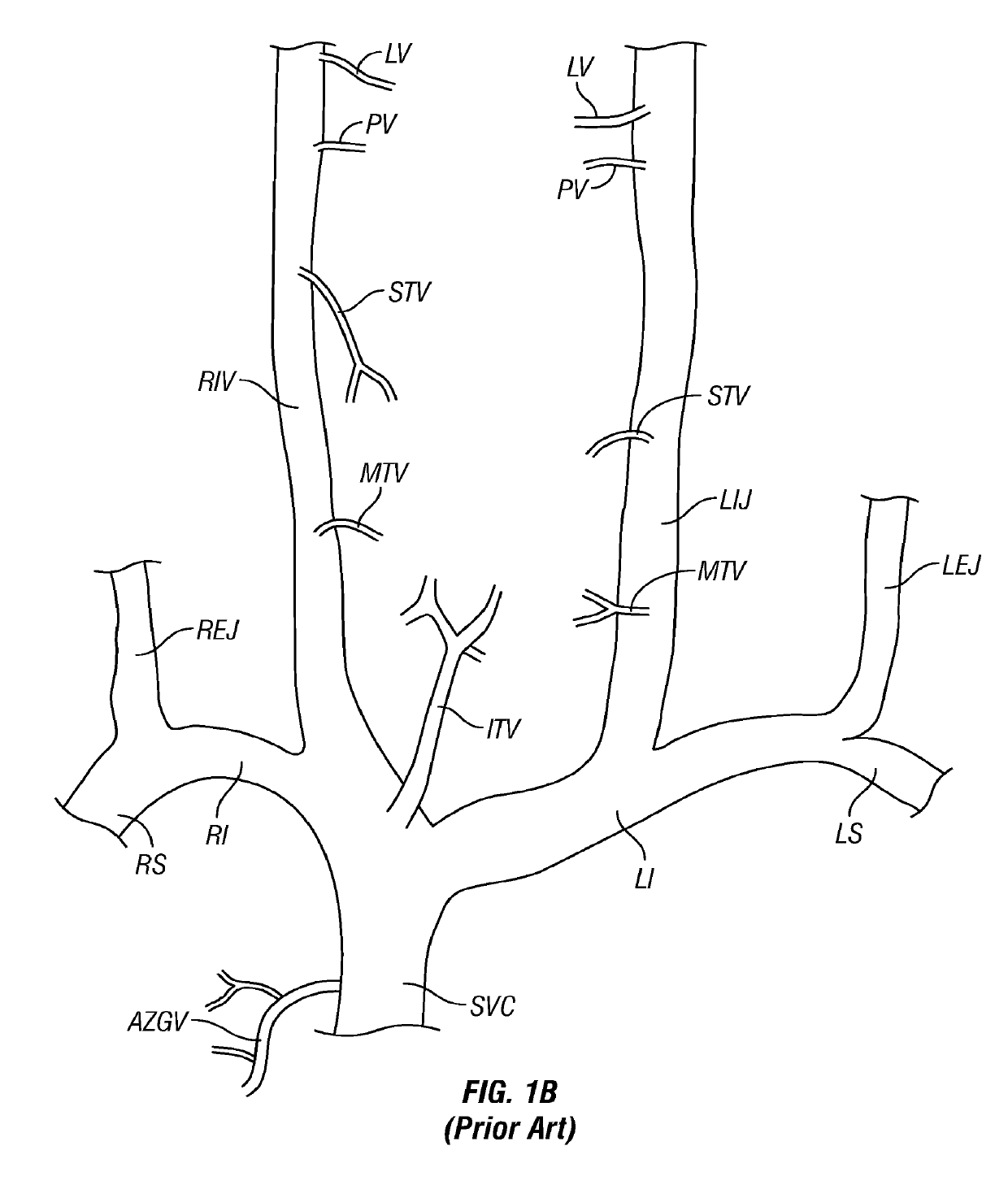 Methods, systems and devices for treatment of cerebrospinal venous insufficiency and multiple sclerosis