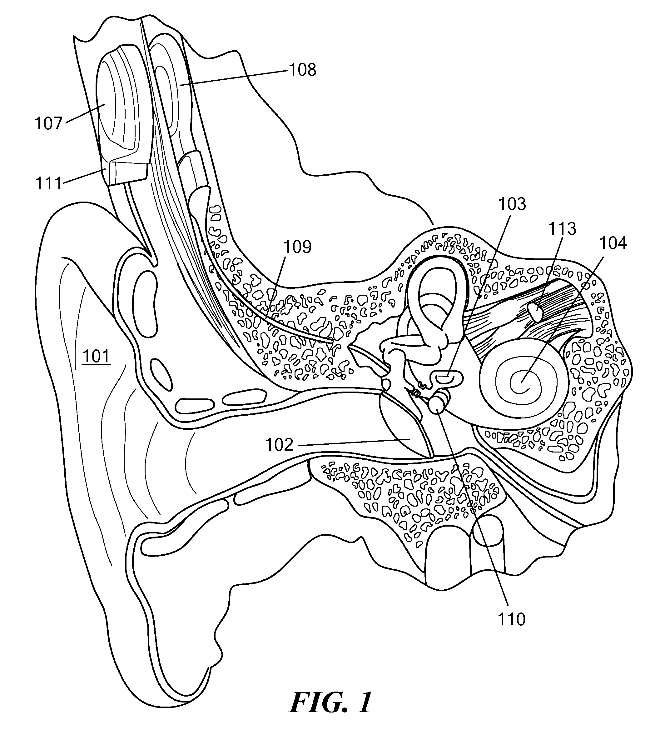 Middle ear implant for otosclerosis