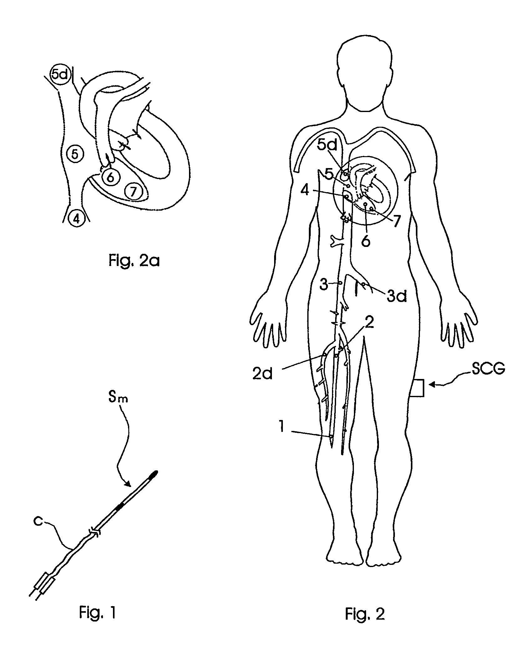 Catheterization method and system for controlling tip displacement