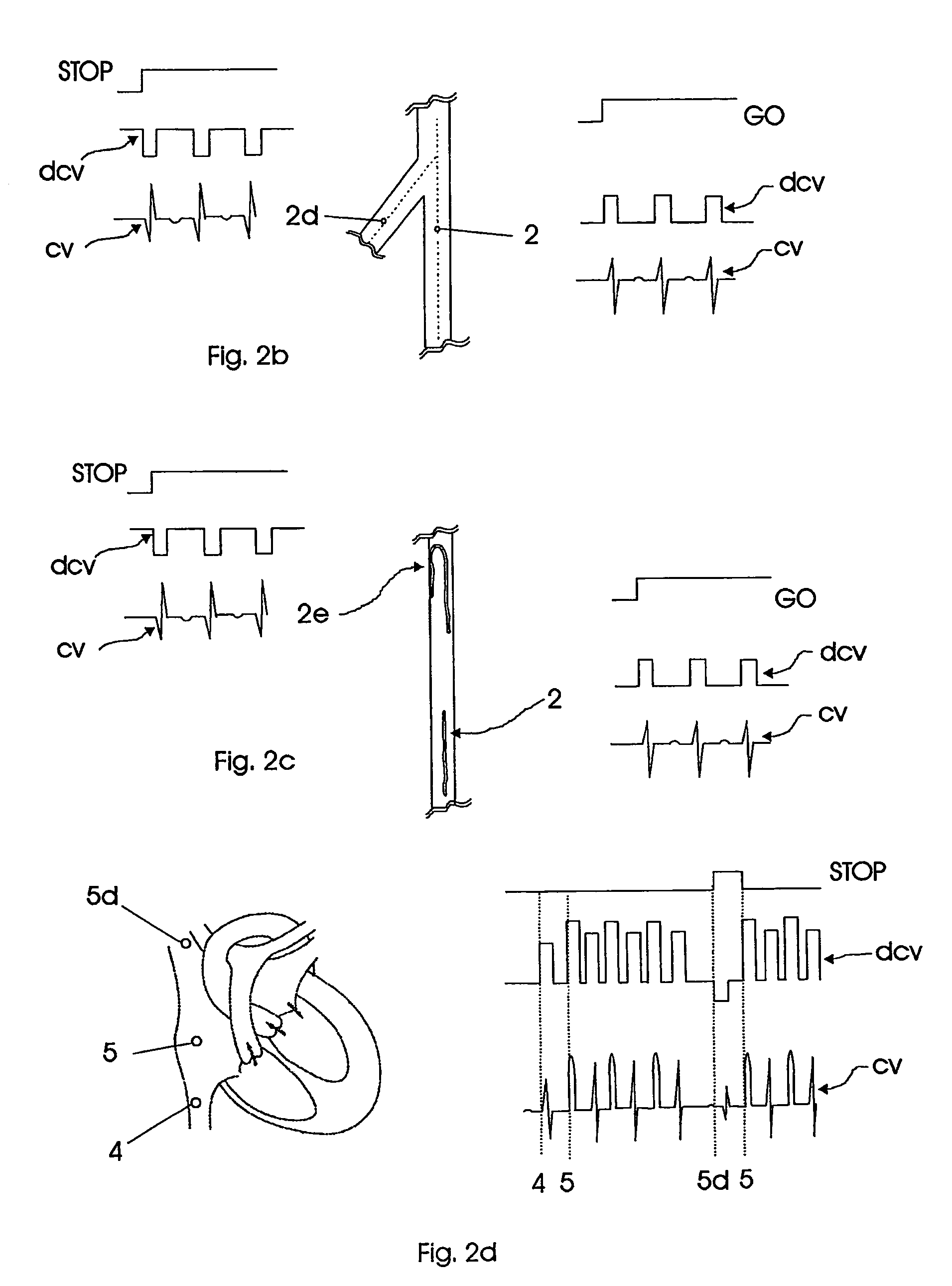 Catheterization method and system for controlling tip displacement