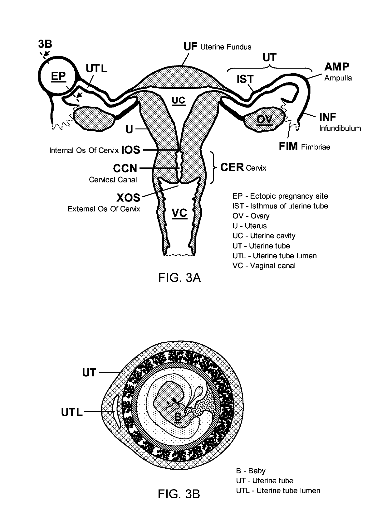 Nondestructive means of ectopic pregnancy management