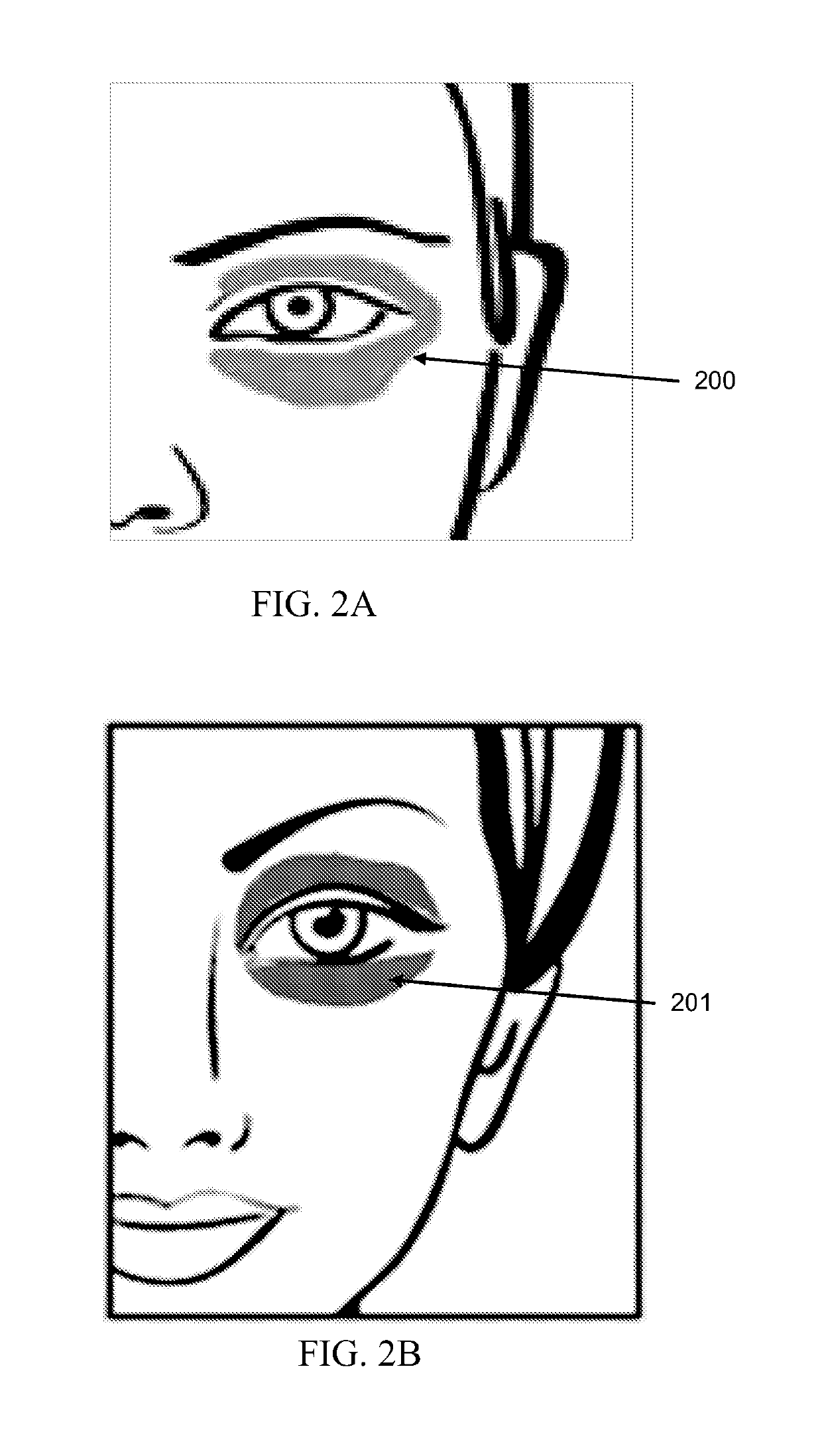 Methods of classifying periorbital dyschromia and systems therefor