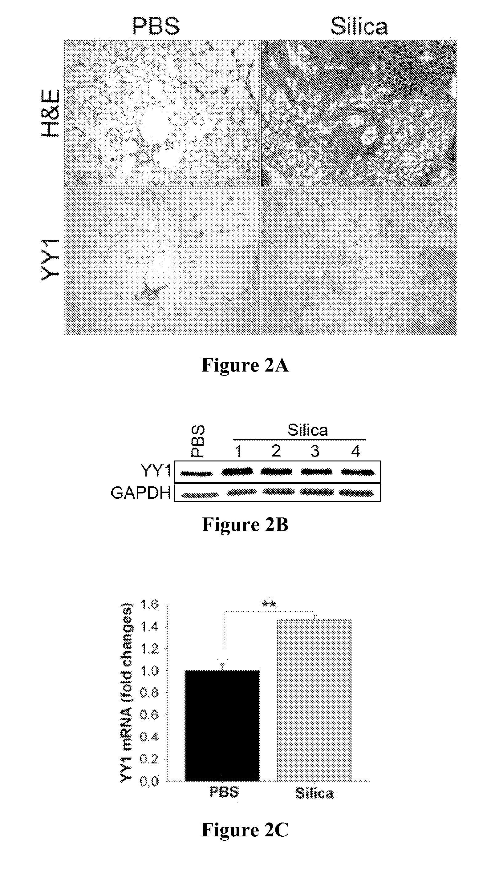 Methods of diagnosing and treating fibrosis