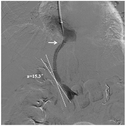 A kit for predicting stent restenosis after tips in patients with liver cirrhosis