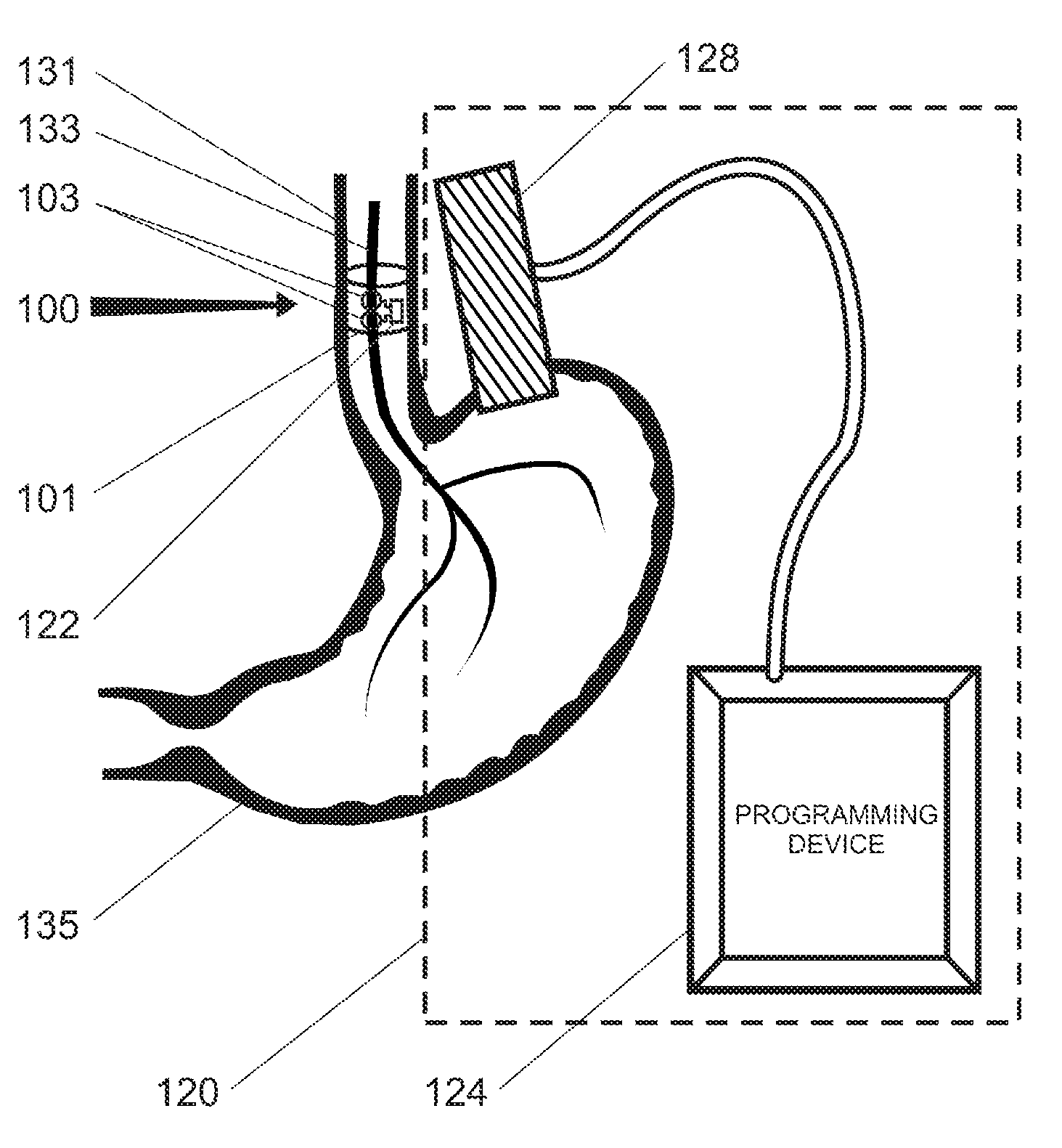 Non-surgical device and methods for trans-esophageal vagus nerve stimulation