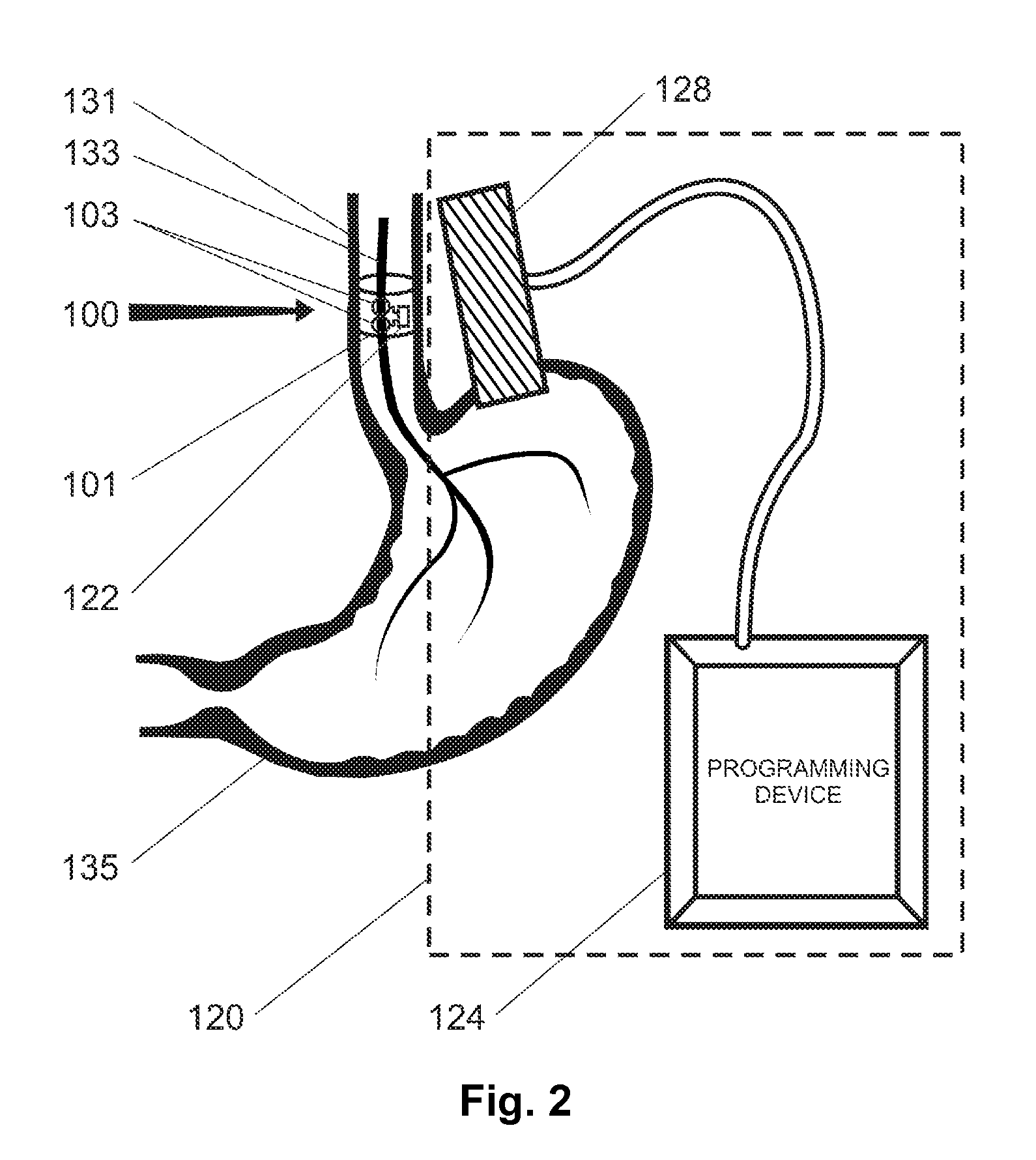 Non-surgical device and methods for trans-esophageal vagus nerve stimulation