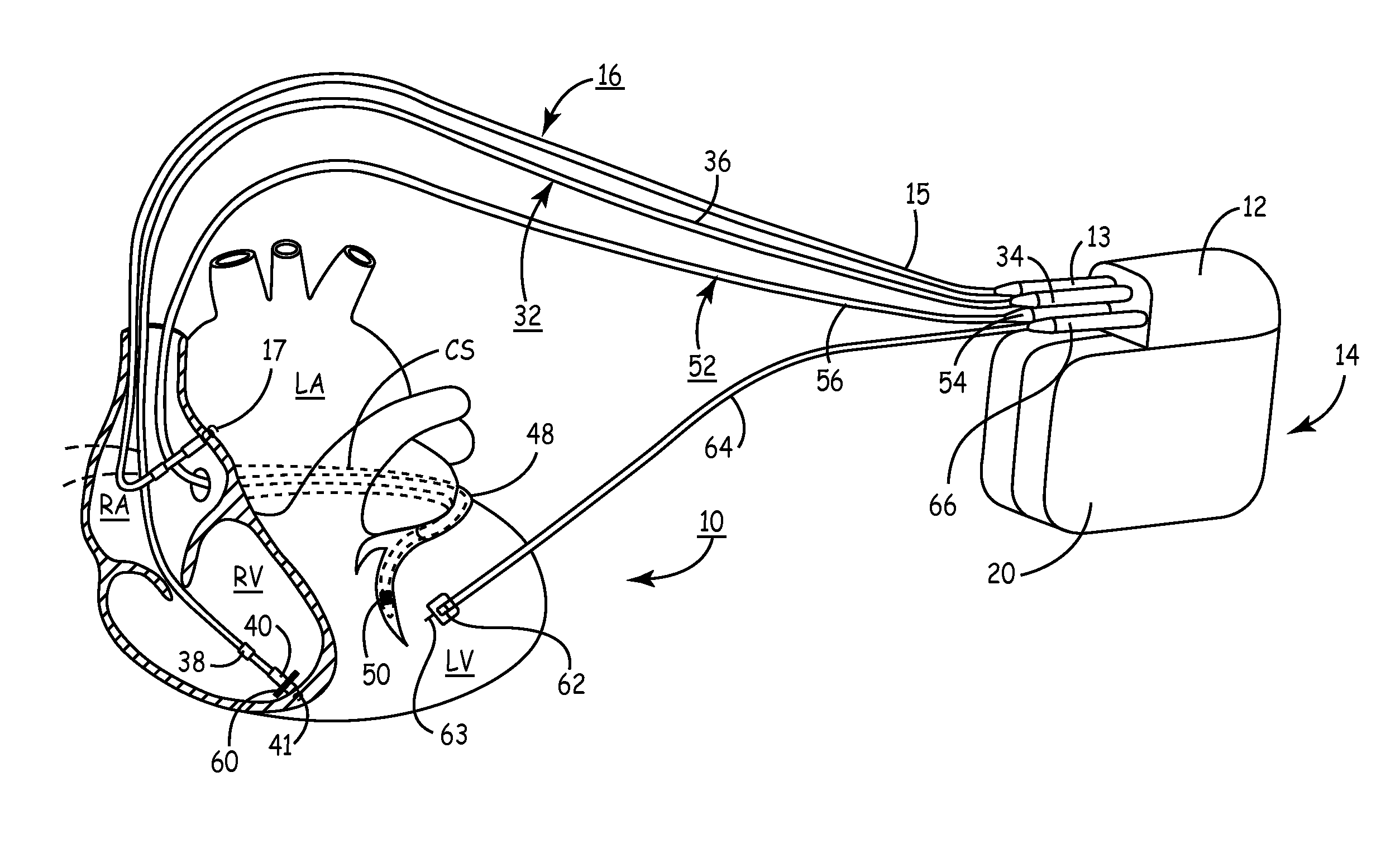 Method and apparatus for assessing left ventricular function and optimizing cardiac pacing intervals based on left ventricular wall motion