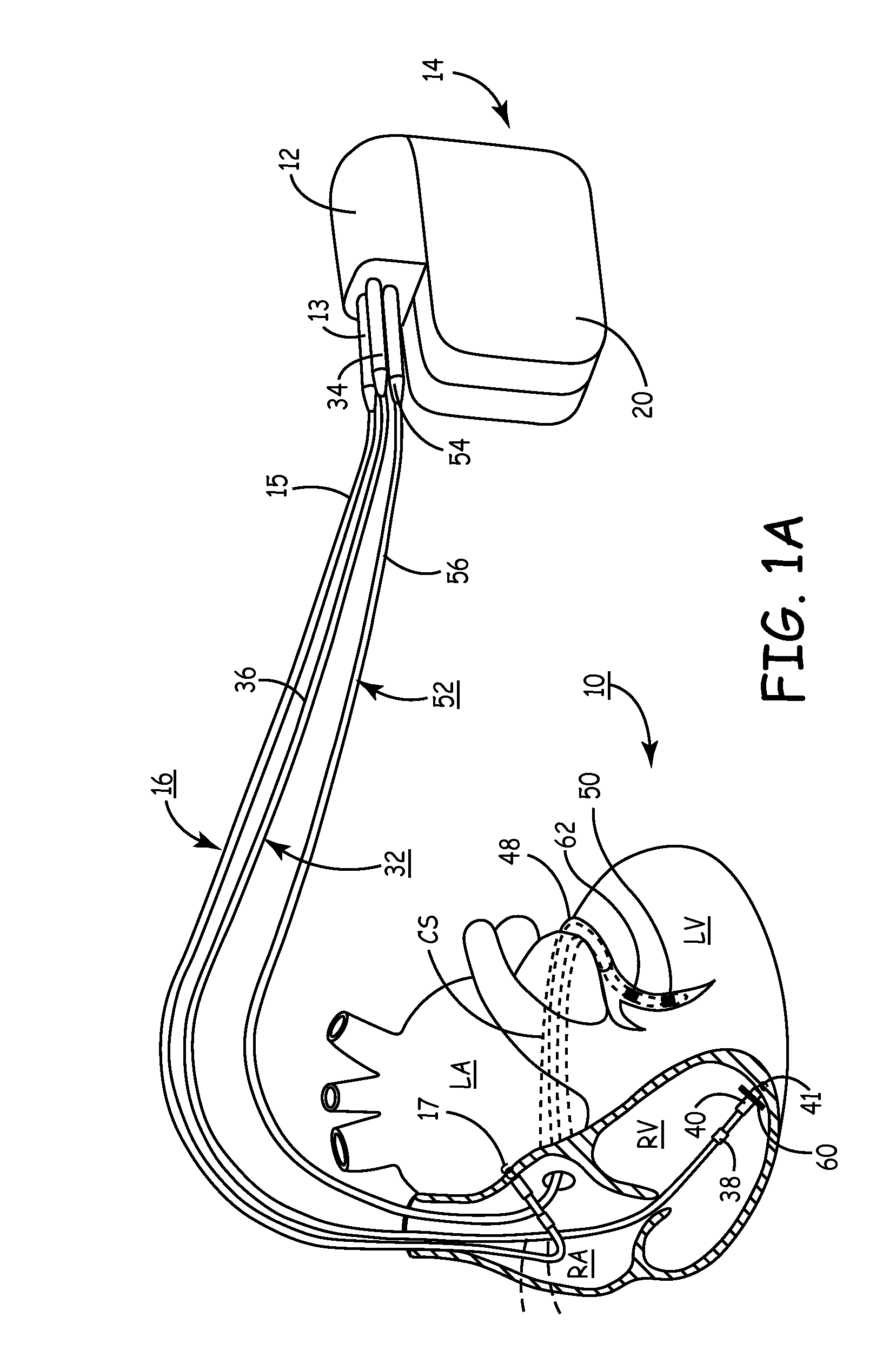 Method and apparatus for assessing left ventricular function and optimizing cardiac pacing intervals based on left ventricular wall motion