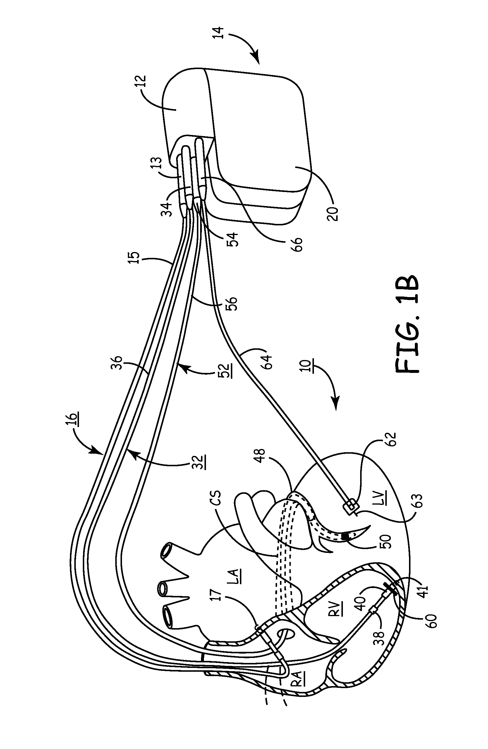 Method and apparatus for assessing left ventricular function and optimizing cardiac pacing intervals based on left ventricular wall motion