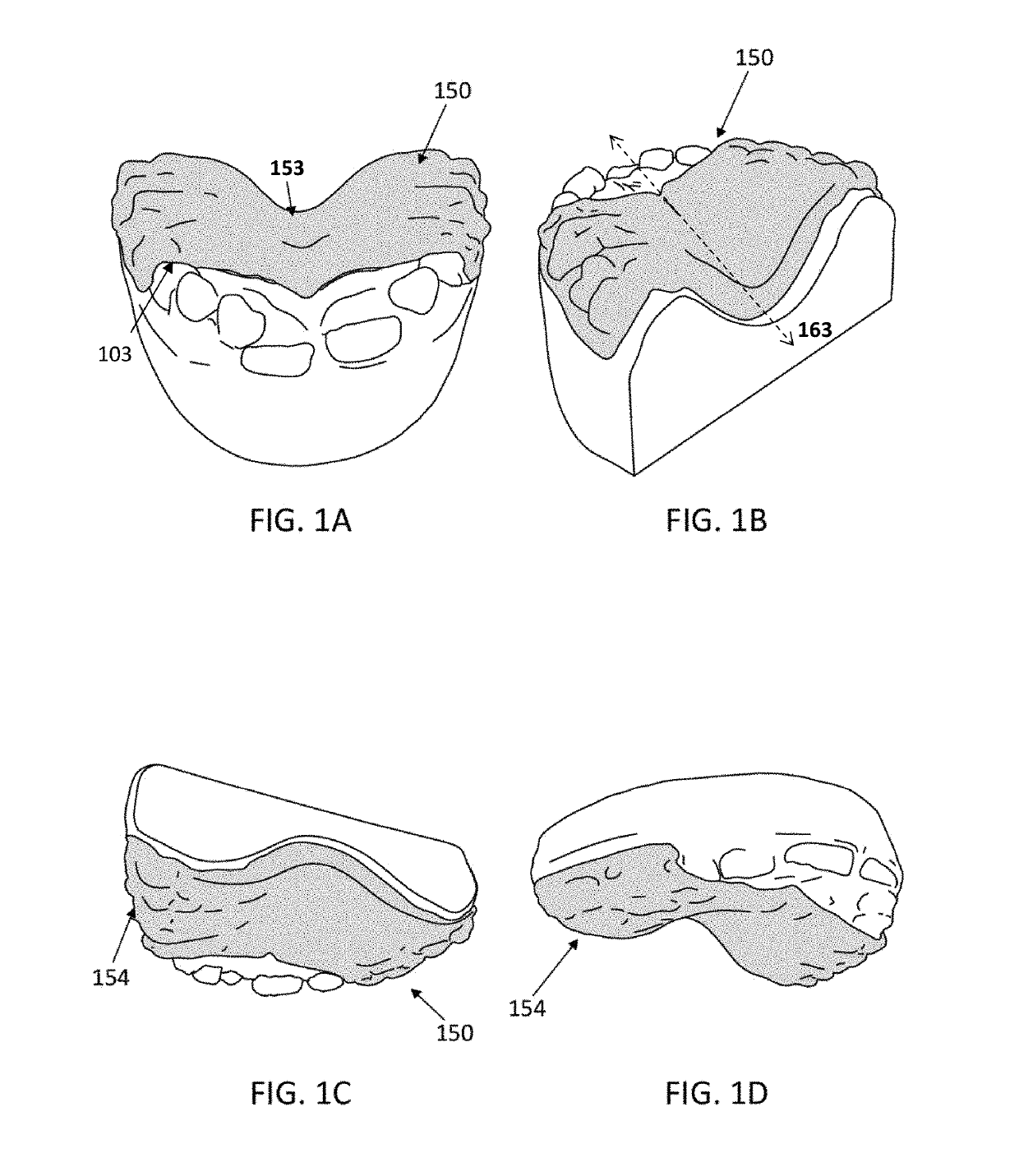 Releasable palatal expanders