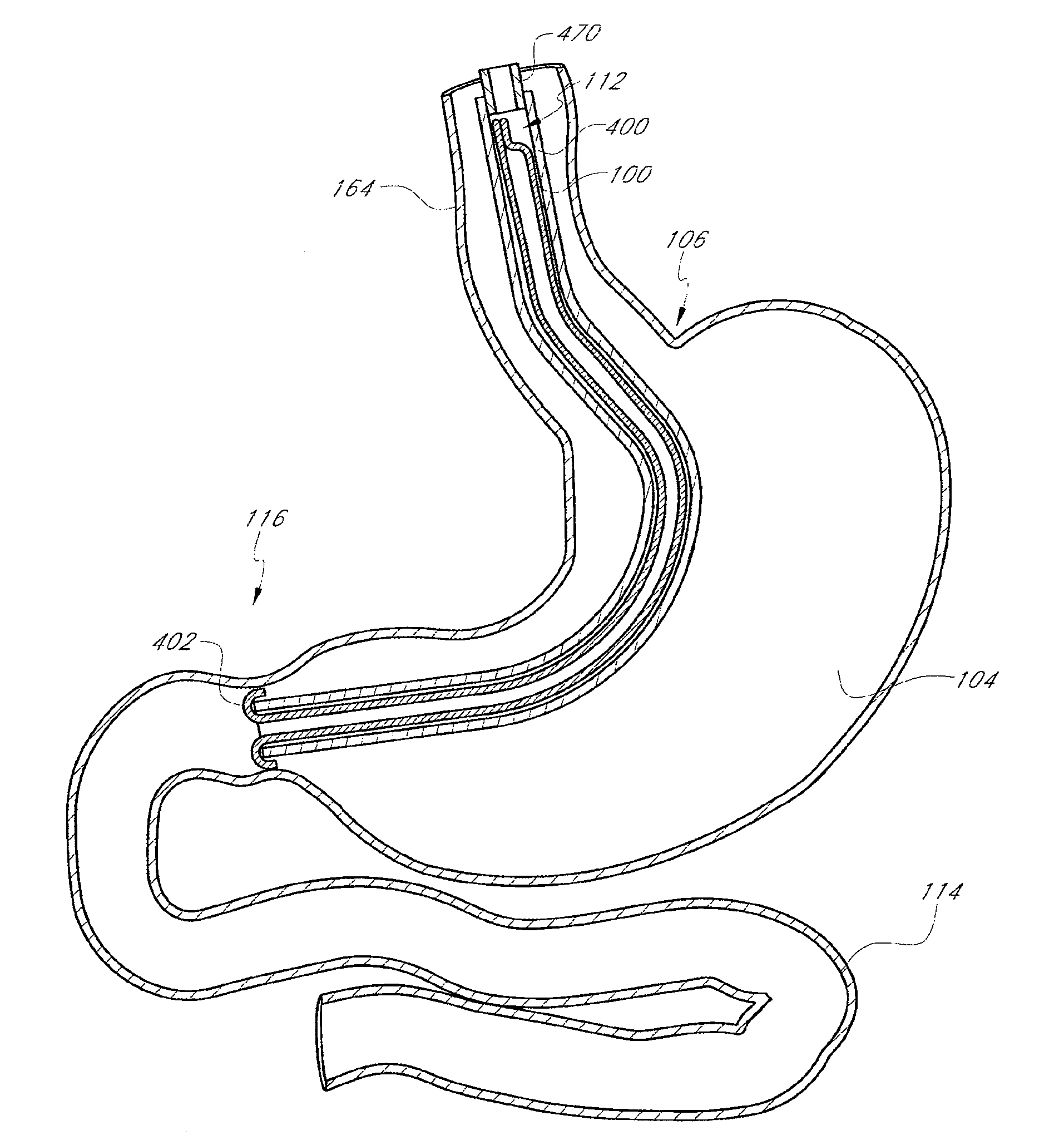 Toposcopic methods and devices for delivering a sleeve having axially compressed and elongate configurations