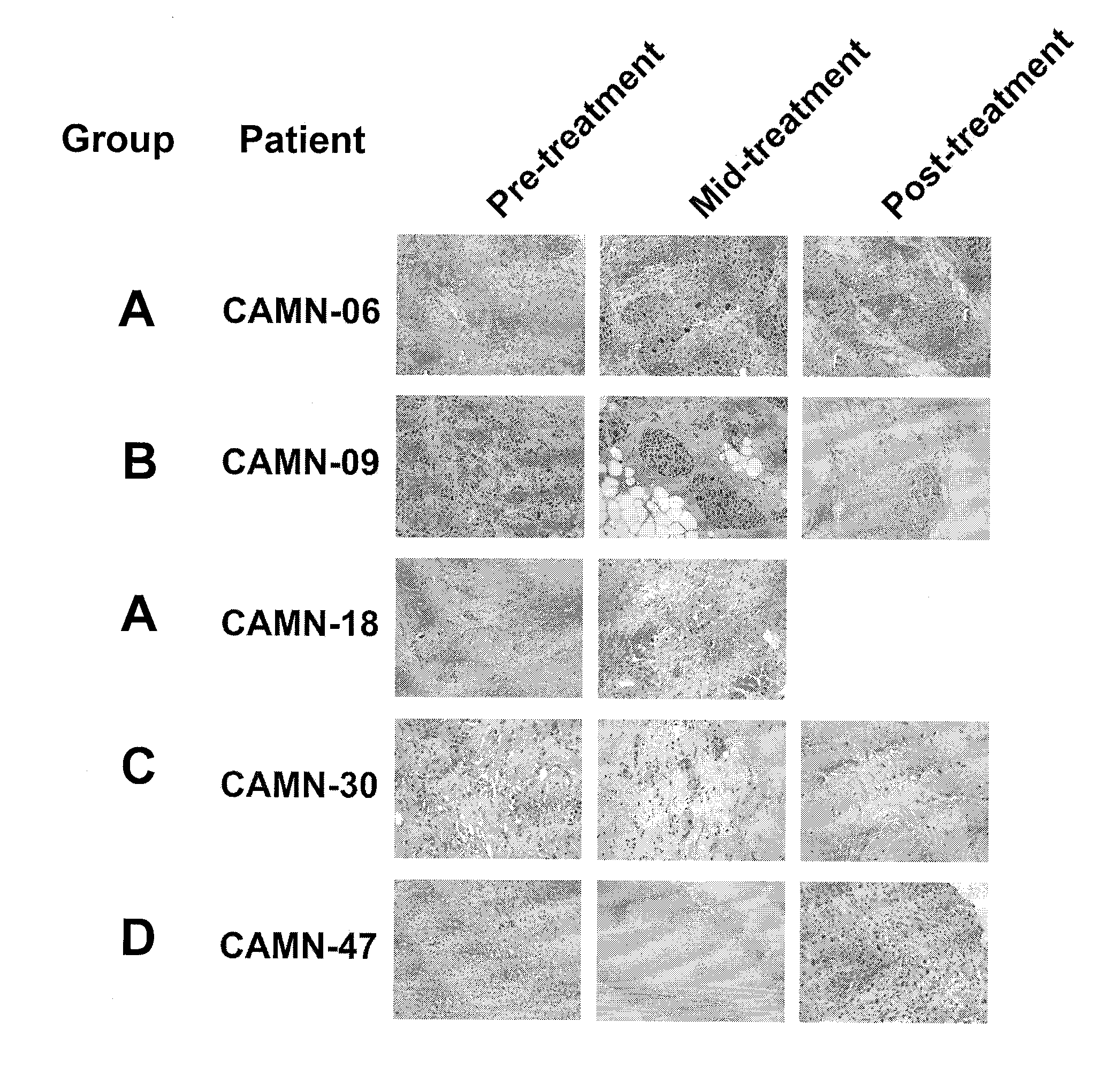 Method of using tumour RNA integrity to measure response to chemotherapy in cancer patients