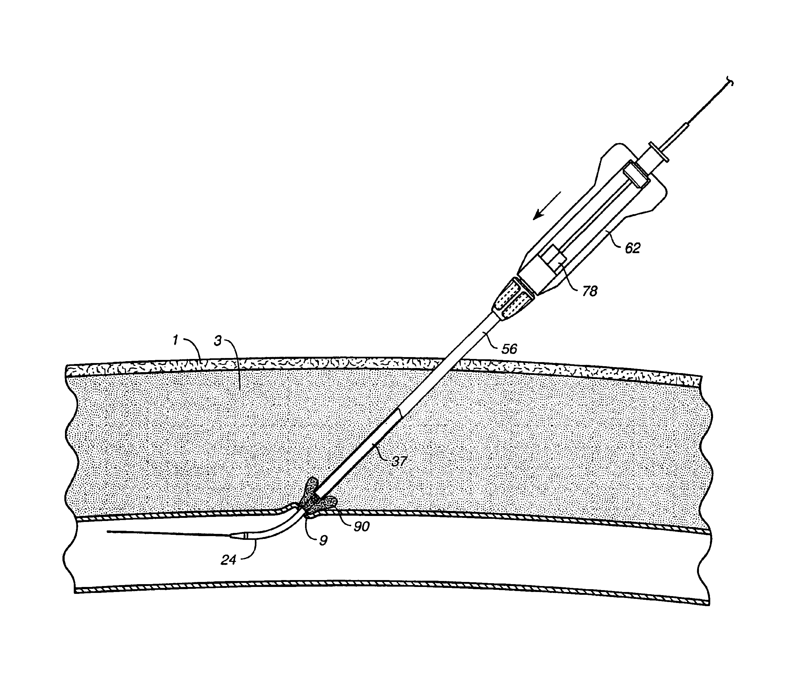 Depth and puncture control for blood vessel hemostasis system