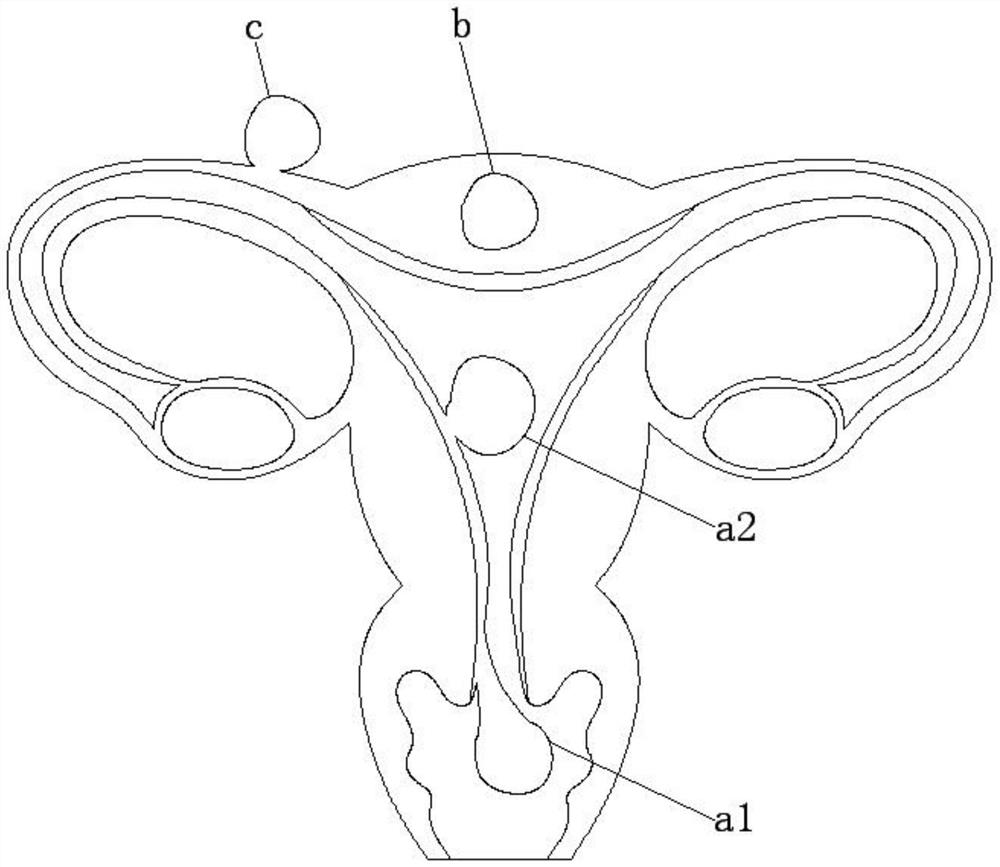 Hysteromyoma sampling device for gynecology department