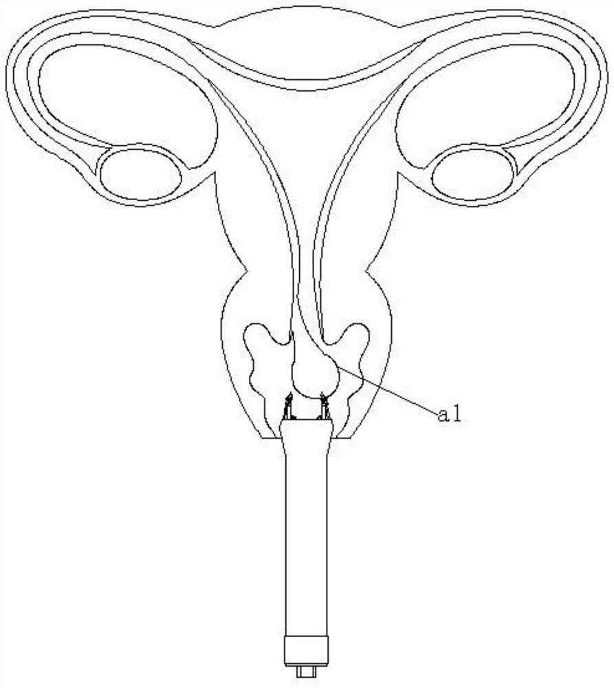 Hysteromyoma sampling device for gynecology department