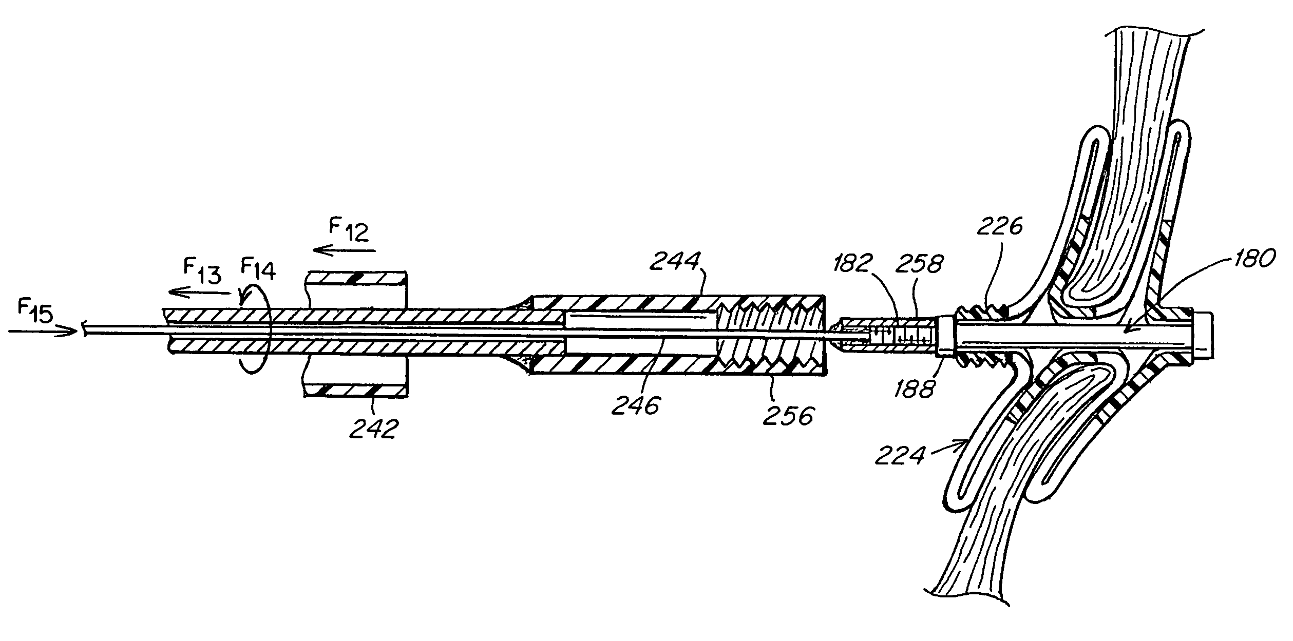 Occluder device double securement system for delivery/recovery of such occluder device