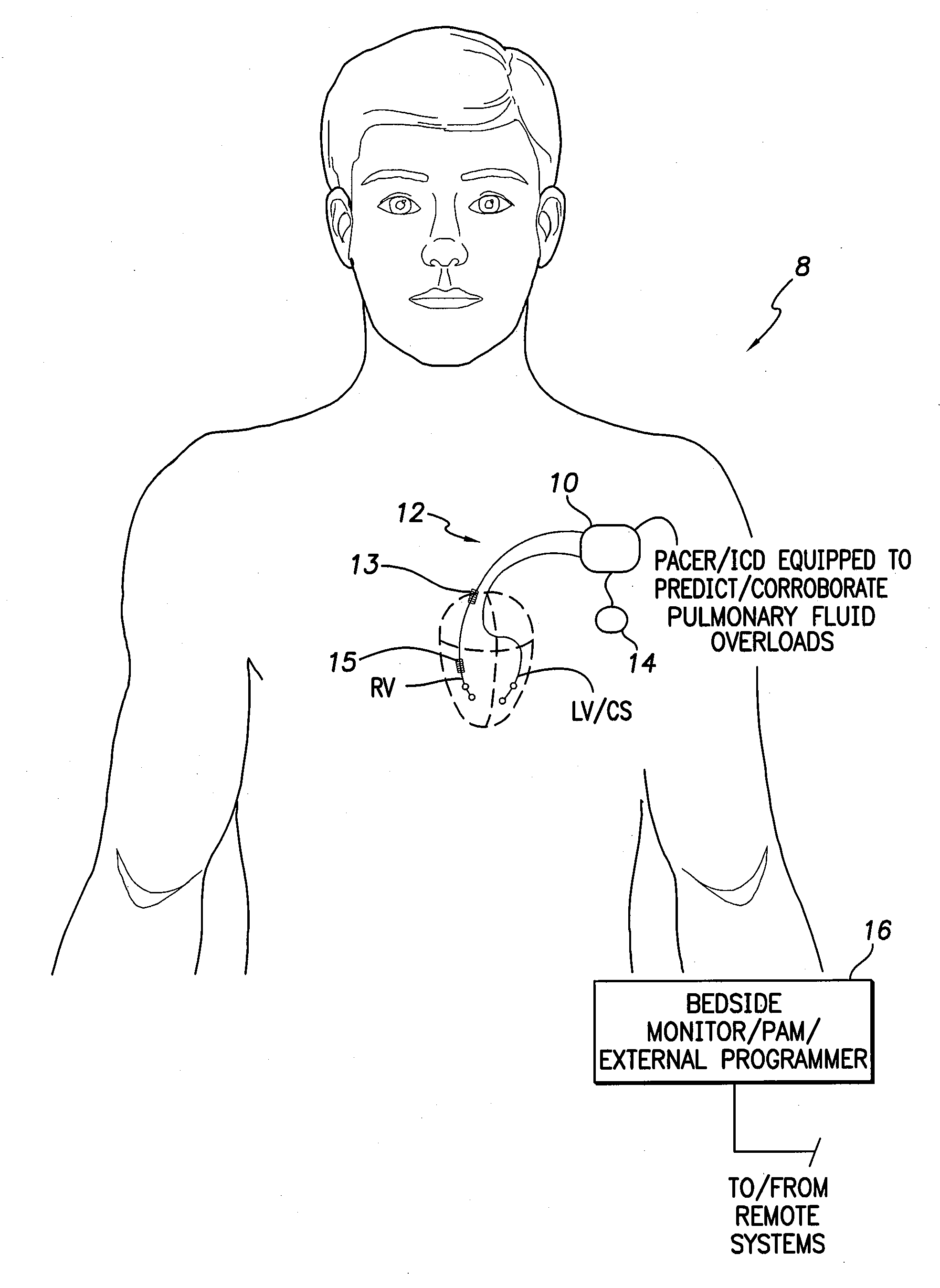 Systems and methods for predicting and corroborating pulmonary fluid overloads using an implantable medical device