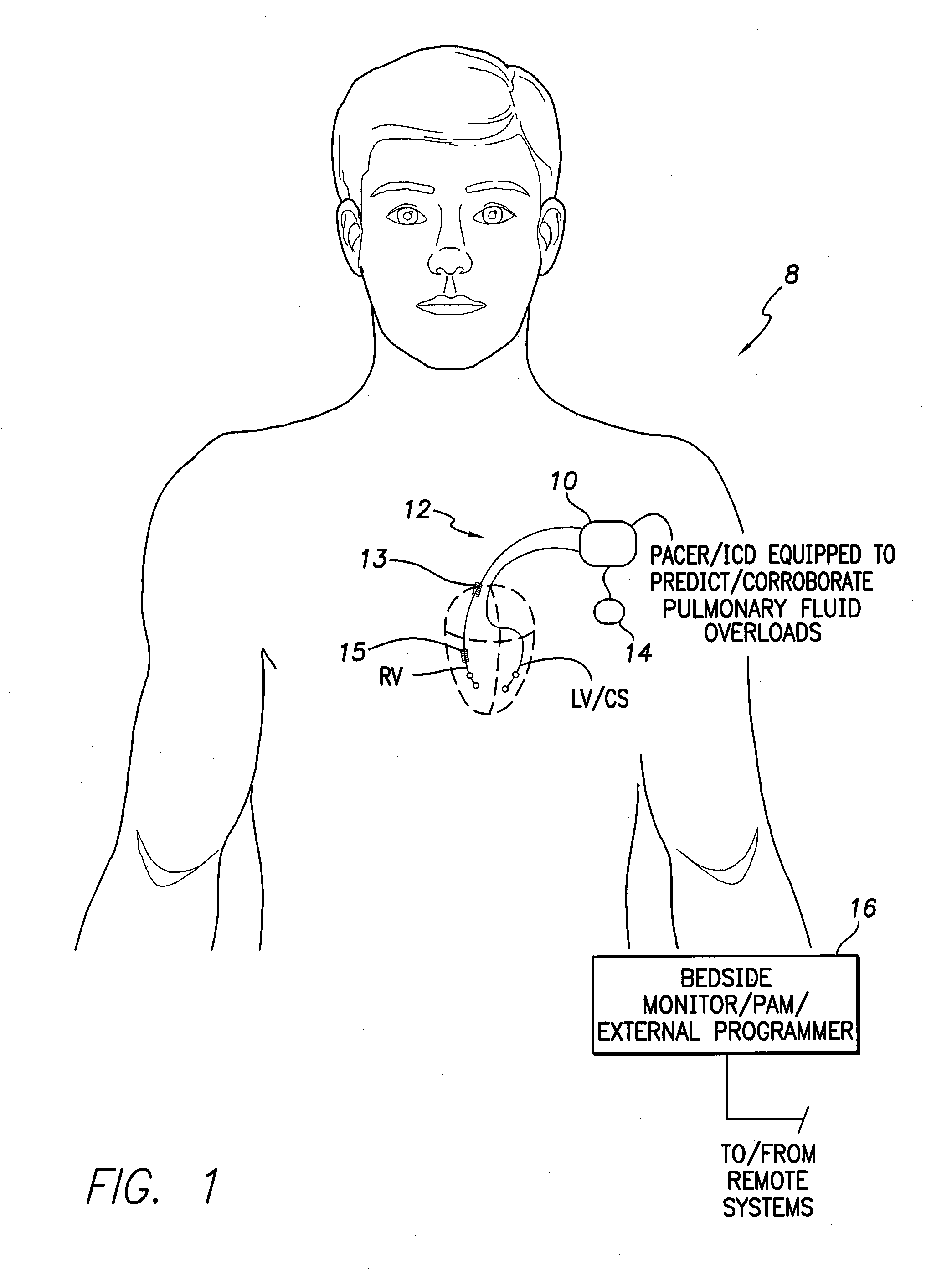 Systems and methods for predicting and corroborating pulmonary fluid overloads using an implantable medical device