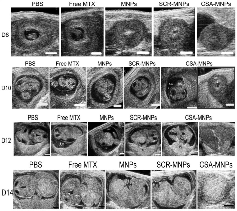 Placenta-targeted nanoparticle for medical abortion and its preparation method and application