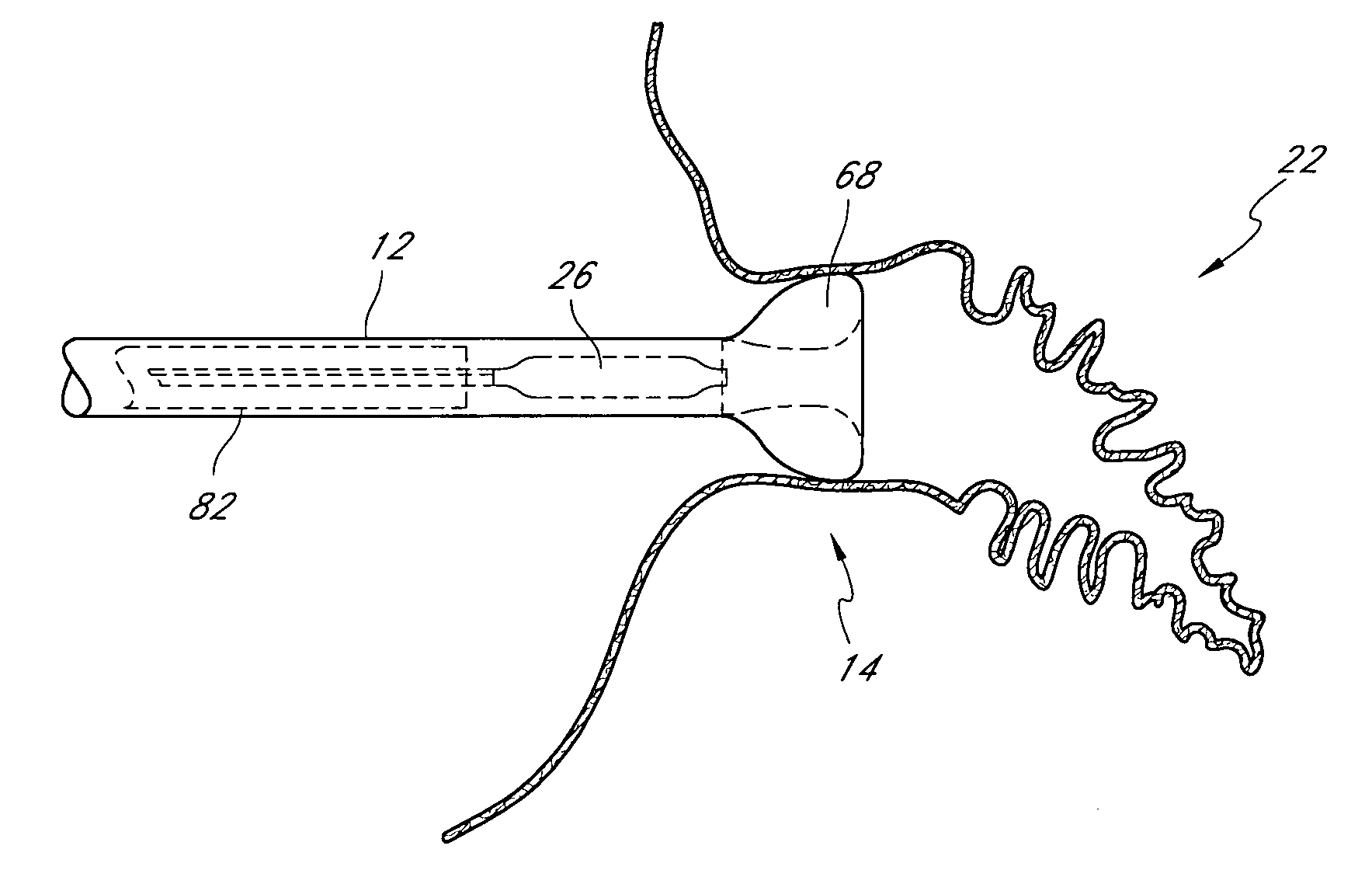 Method for accessing the left atrial appendage with a balloon-tipped transeptal sheath