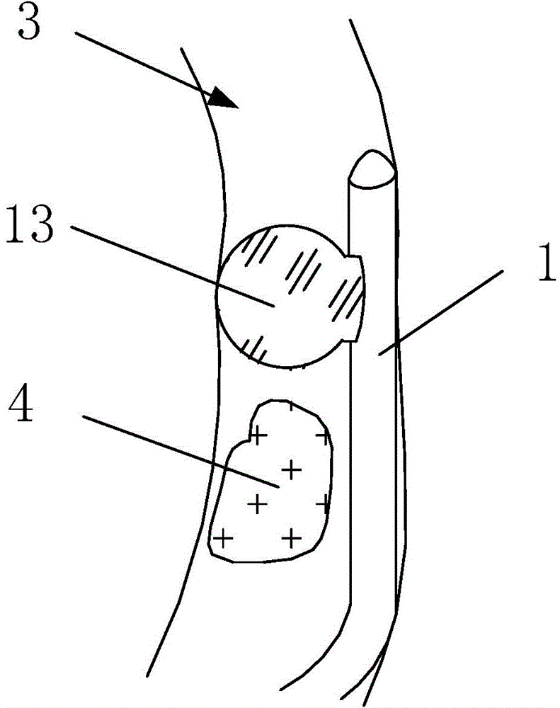 Novel blocking type calculus removing catheter