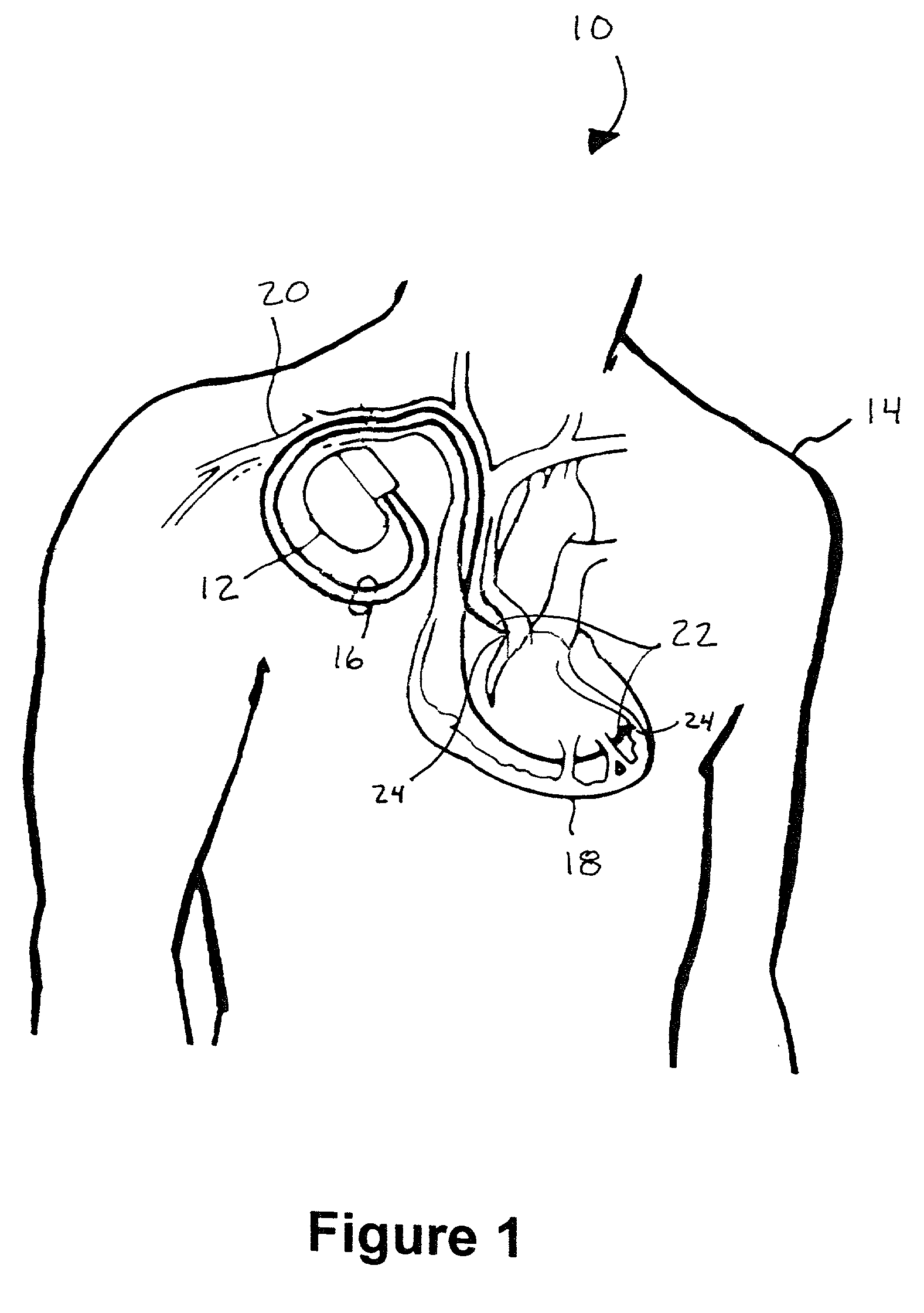 Method and apparatus for shielding wire for MRI resistant electrode systems