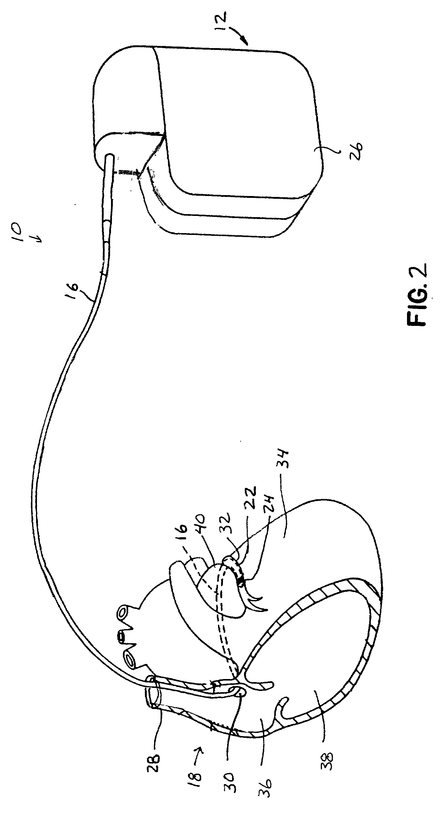 Method and apparatus for shielding wire for MRI resistant electrode systems