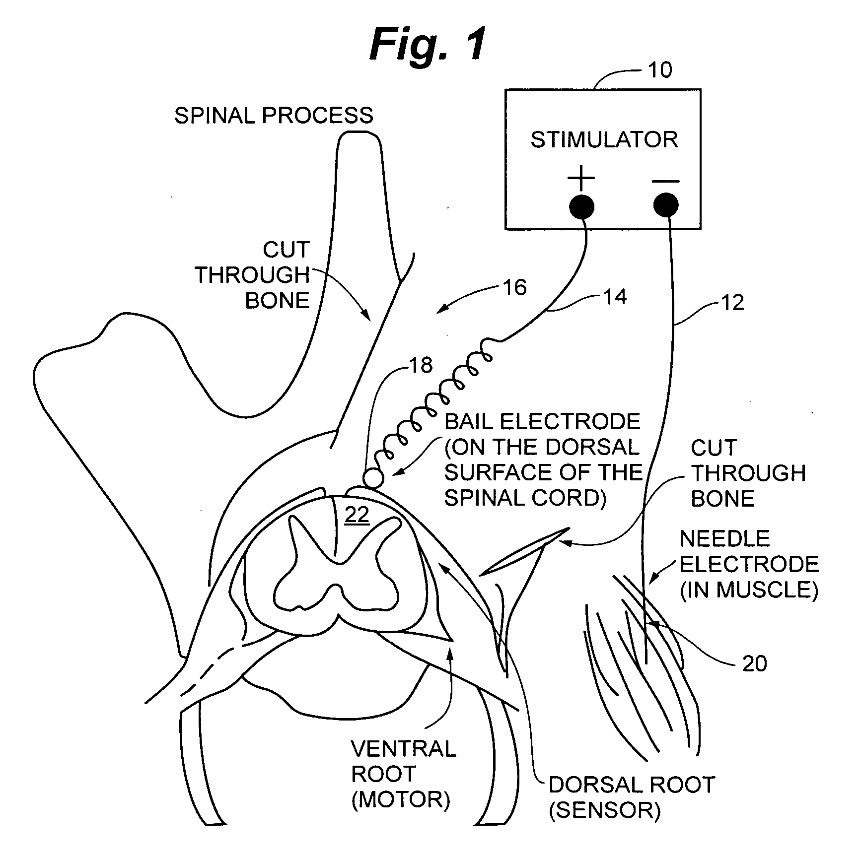 Method and apparatus for improving renal function