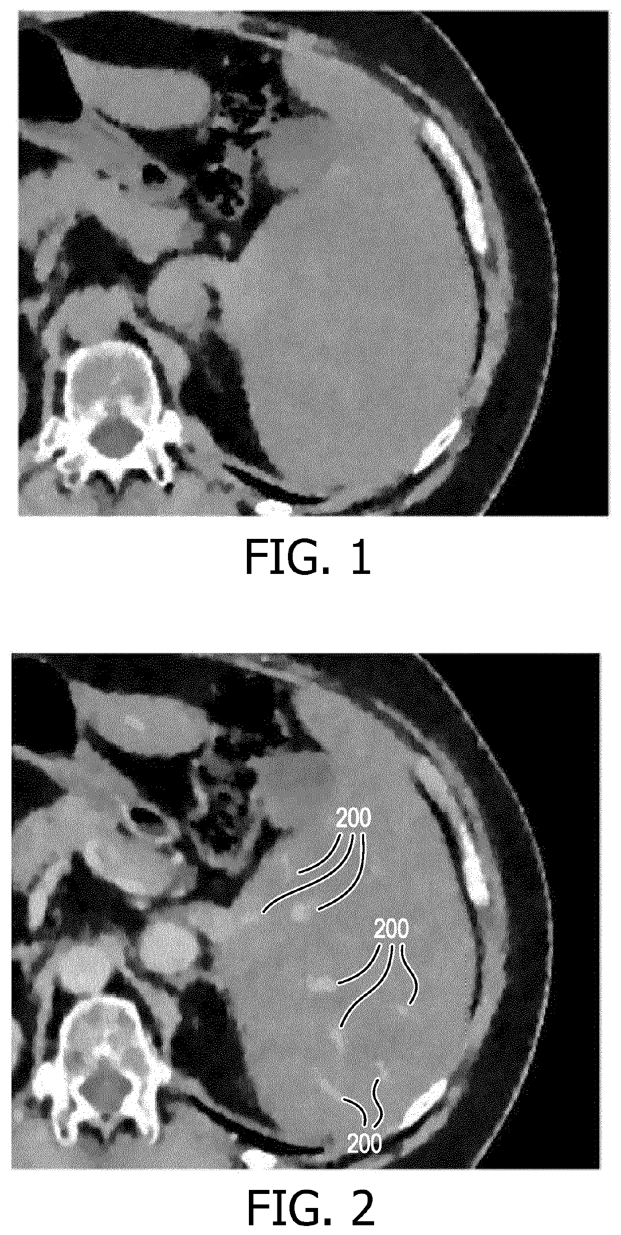 Detection and/or correction of residual iodine artifacts in spectral computed tomography (CT) imaging