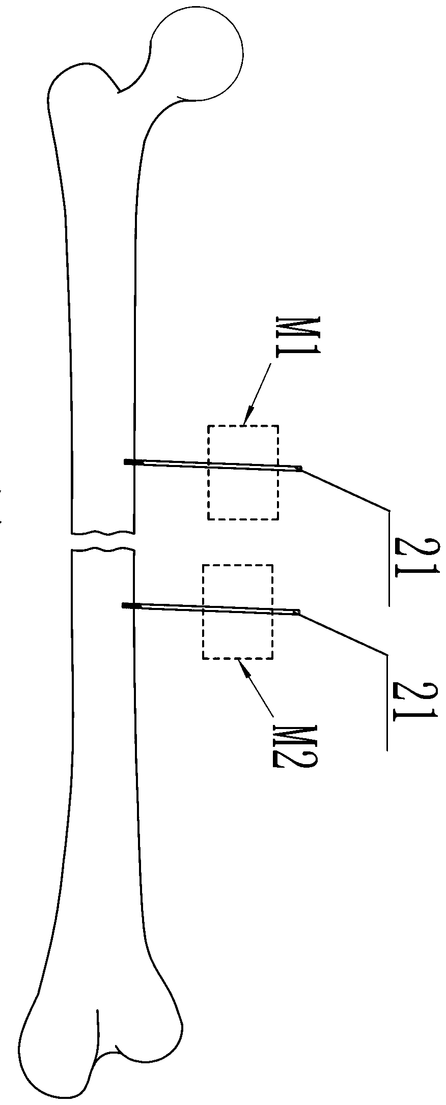 Fracture traction reduction device