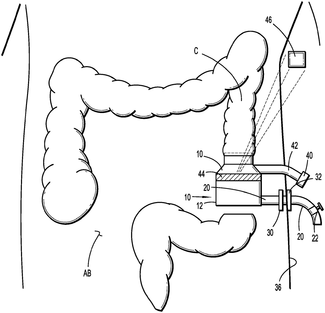 Internal colostomy catheter