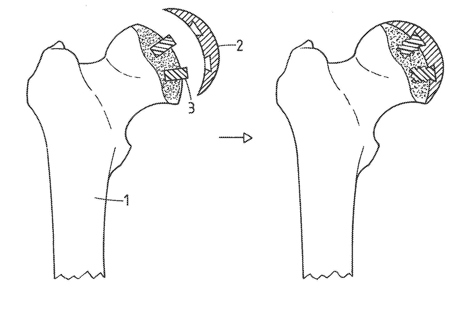 Method for fastening an implant to bone tissue and corresponding implant system