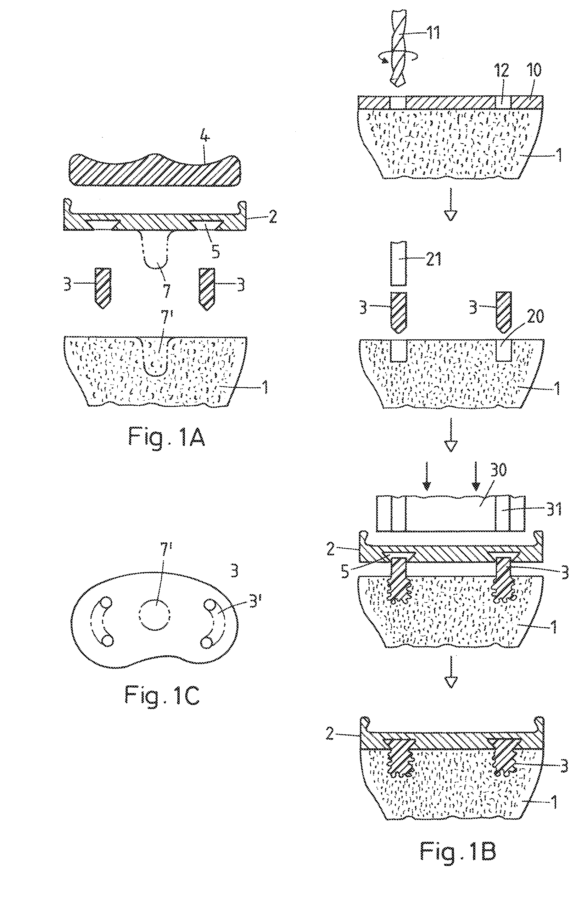 Method for fastening an implant to bone tissue and corresponding implant system