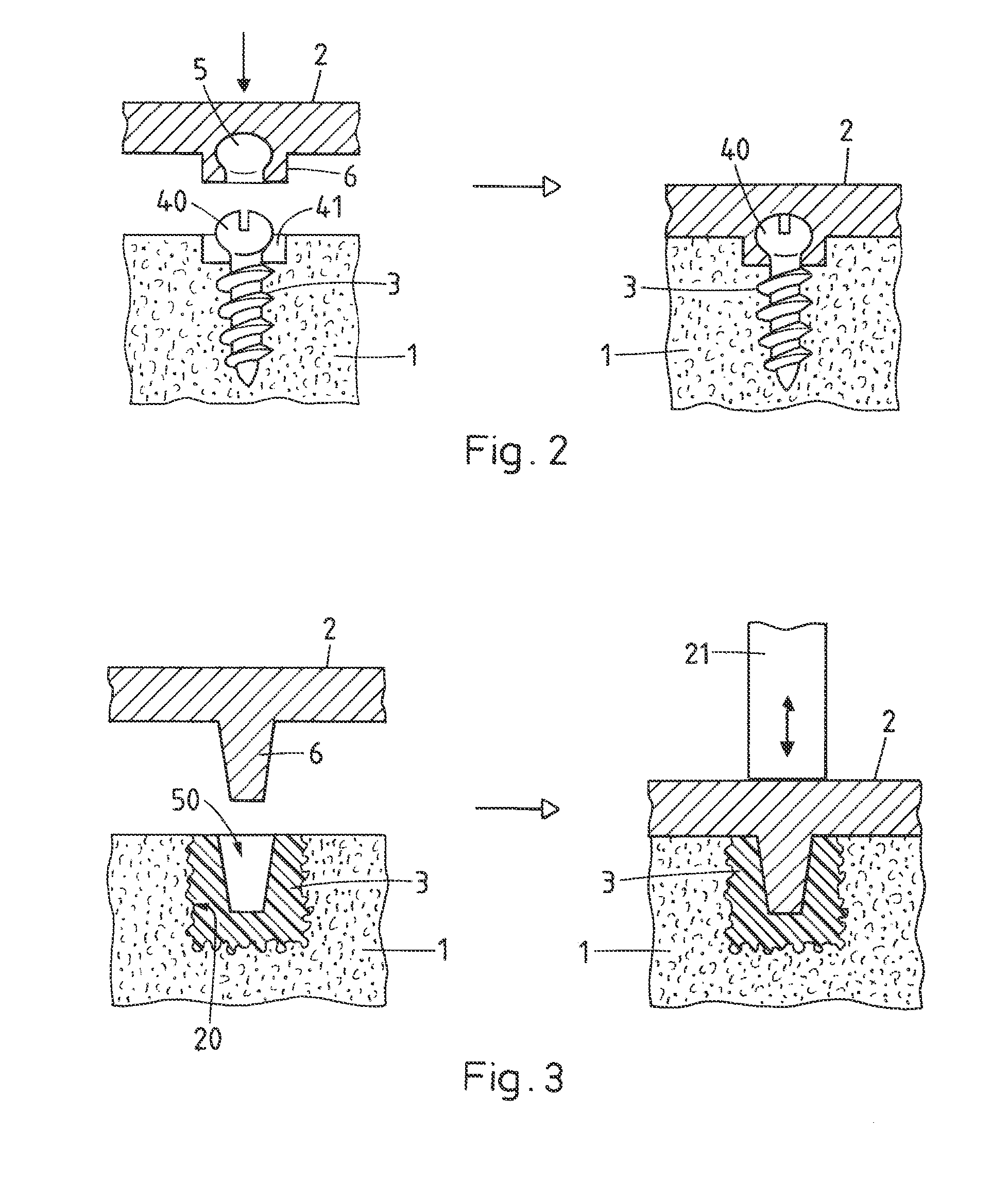 Method for fastening an implant to bone tissue and corresponding implant system