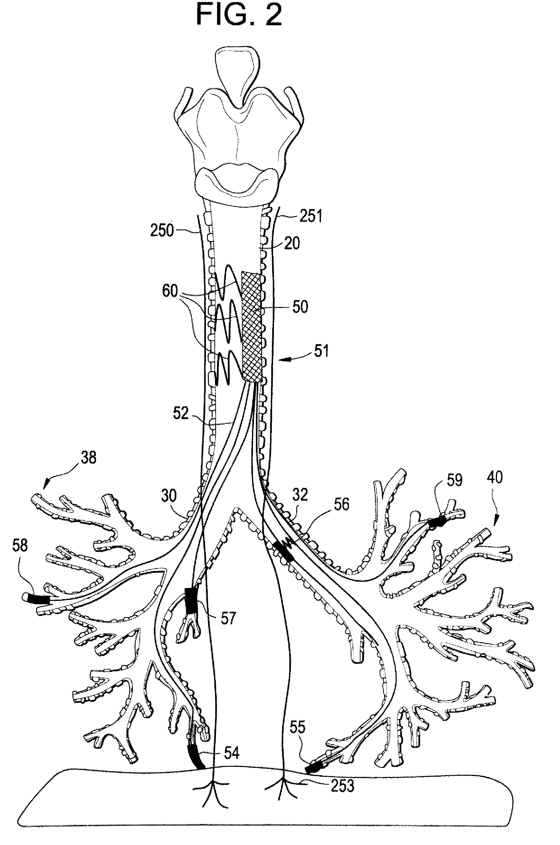 Devices and methods for electrical stimulation of the diaphragm and nerves