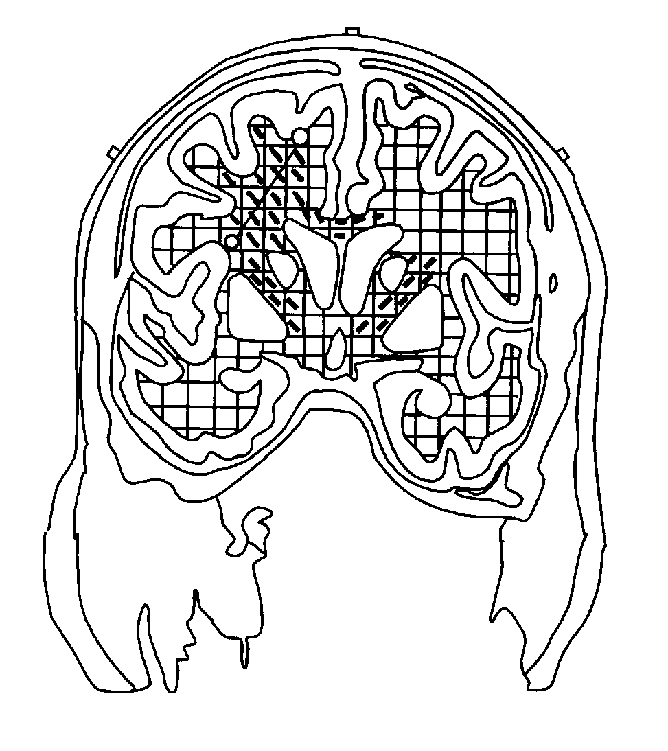 Guided Electrical Transcranial Stimulation (GETS) Technique