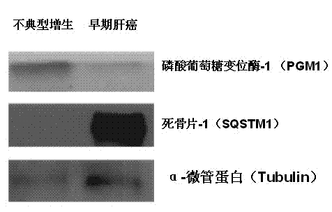 Molecular markers of well-differentiated early liver cancer and use thereof