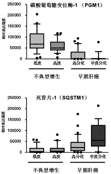 Molecular markers of well-differentiated early liver cancer and use thereof