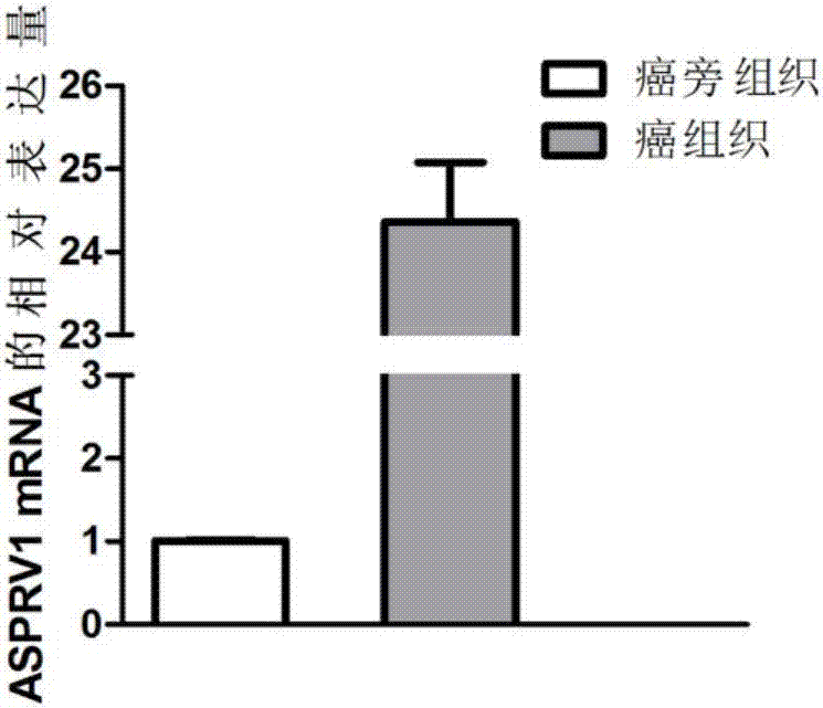 Application of ASPRV1 used as biomarker in diagnosis and treatment of LSCC (laryngeal squamous cell cancer)