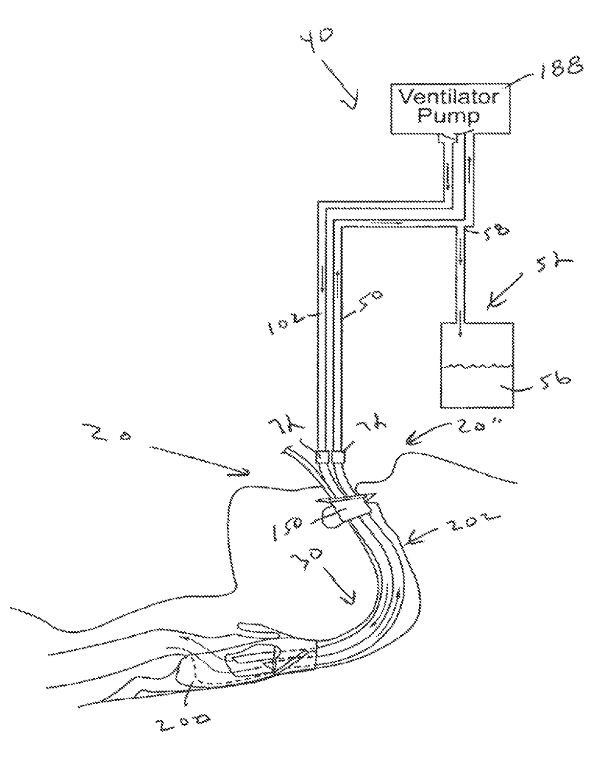 Secretion clearing patient airway management system