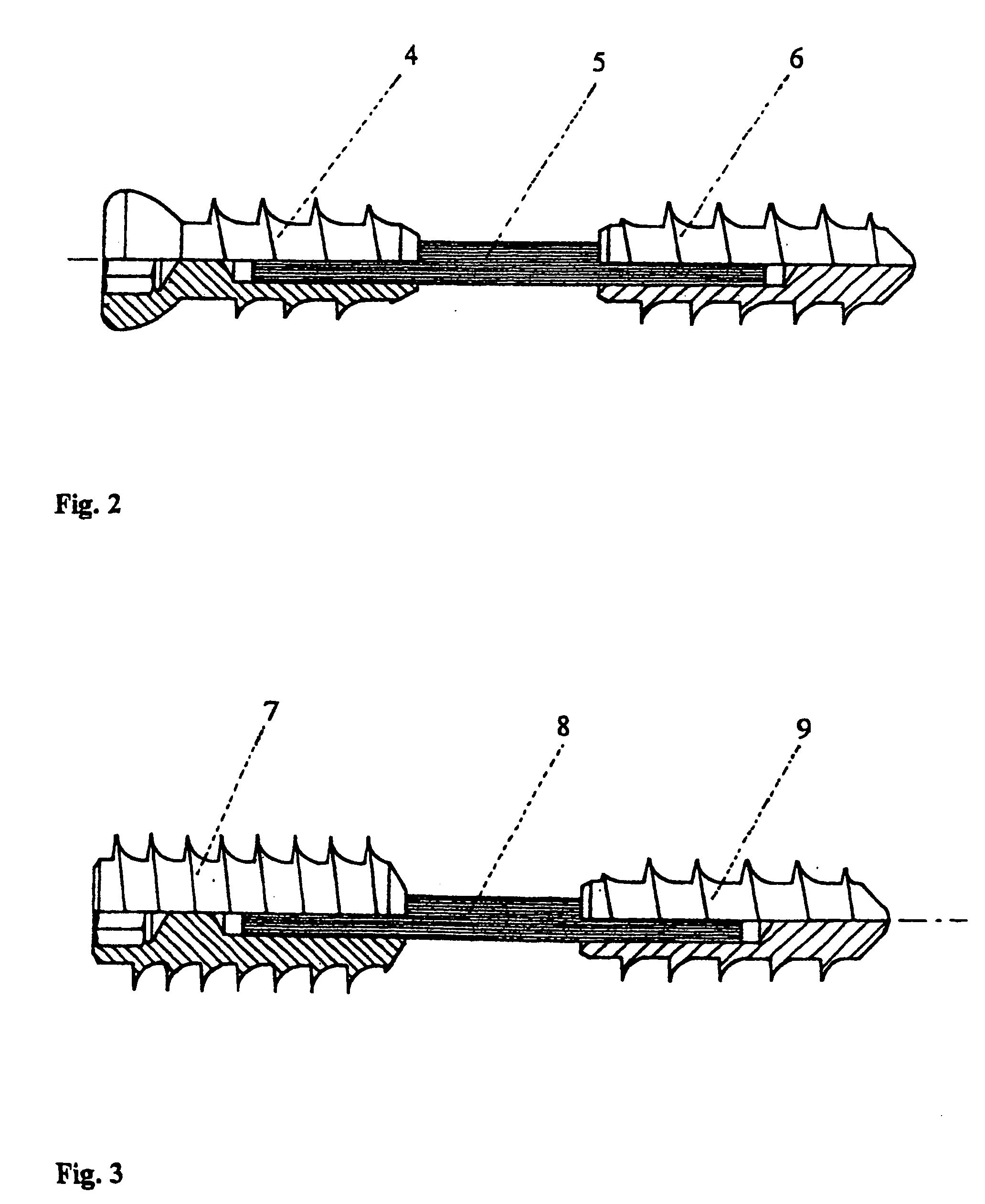Implantable screw for stabilization of a joint or a bone fracture